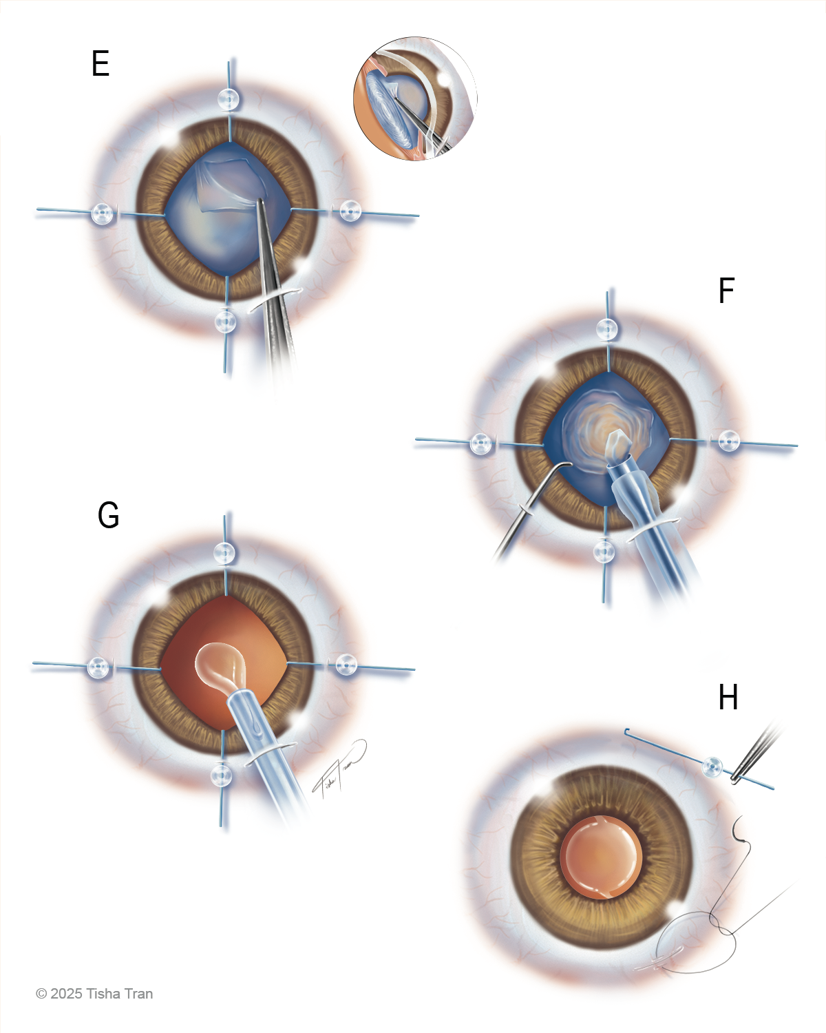 Cataract Surgery B DPI 150.png