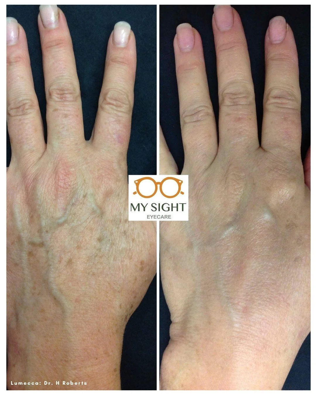 Fall in love with the skin you're in all over again with our #Lumecca treatment! Lumecca treats sunspots, vascular lesions, freckles and age spots. Give us a call to learn more! 😊😊

Check out the link in our profile or call 718-210-2596 for more in