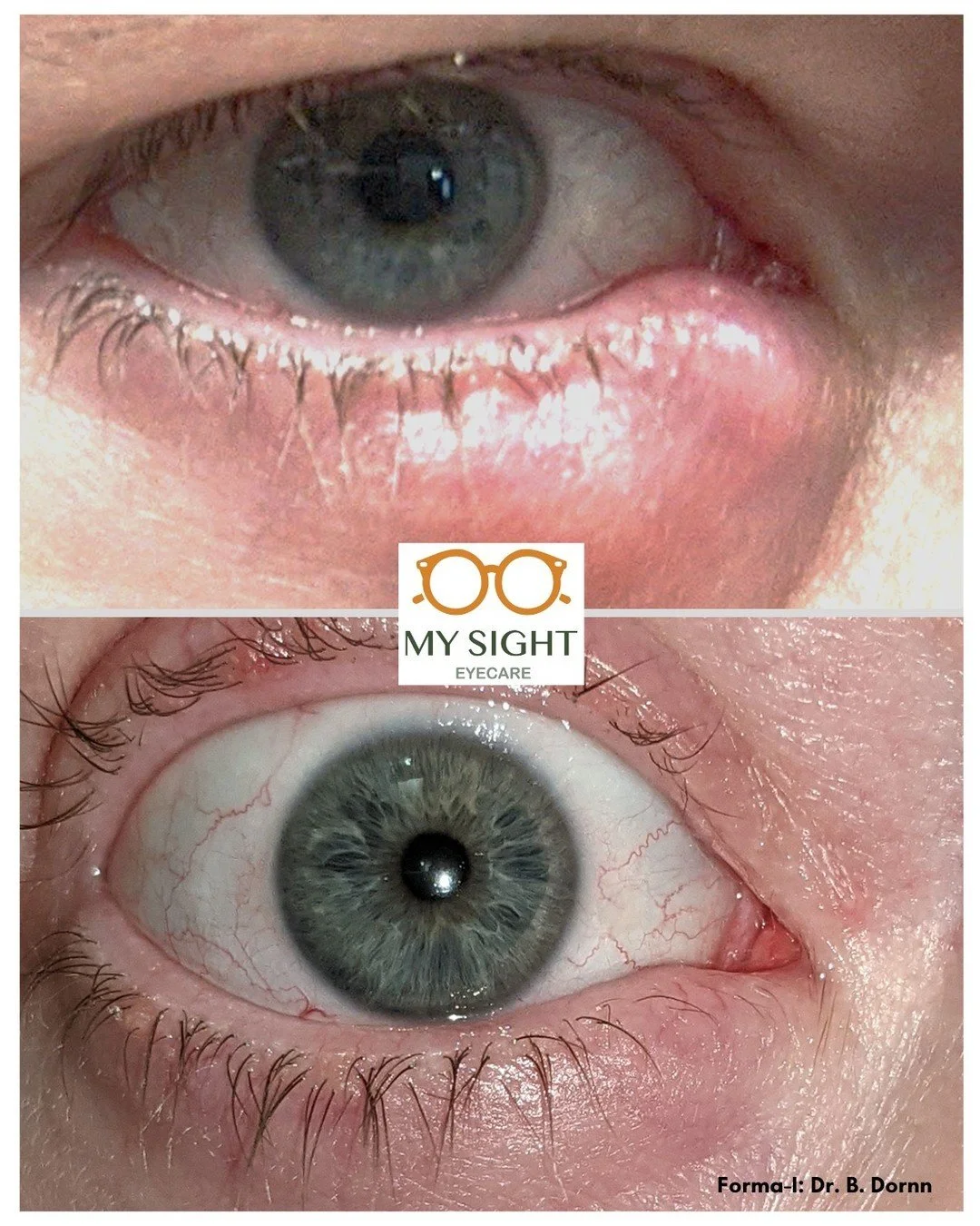 #FormaI is an FDA cleared precision tool, specifically designed for the treatment of the periorbital area. Powered by bi-polar radio-frequency, it improves the blood circulation around the eyes while also improving the function of the meibomian gland