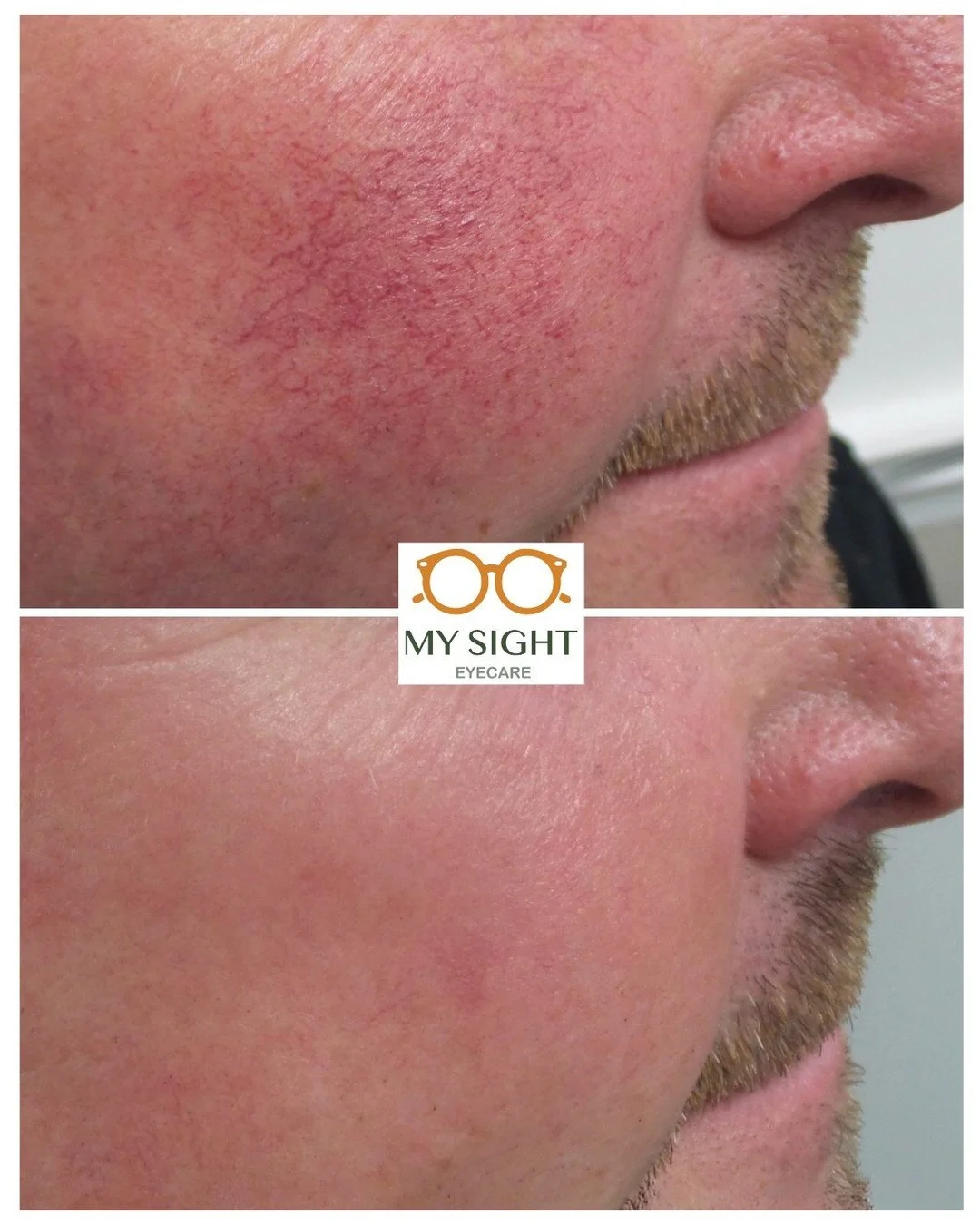 Intense Pulsed Light (IPL) has been FDA cleared for more than 15 years to treat pigment and vascularity. #LumeccaI is one of the most advanced IPL treatments on the market, providing 3X more energy than other IPLs. It also offers a spot-sized applica