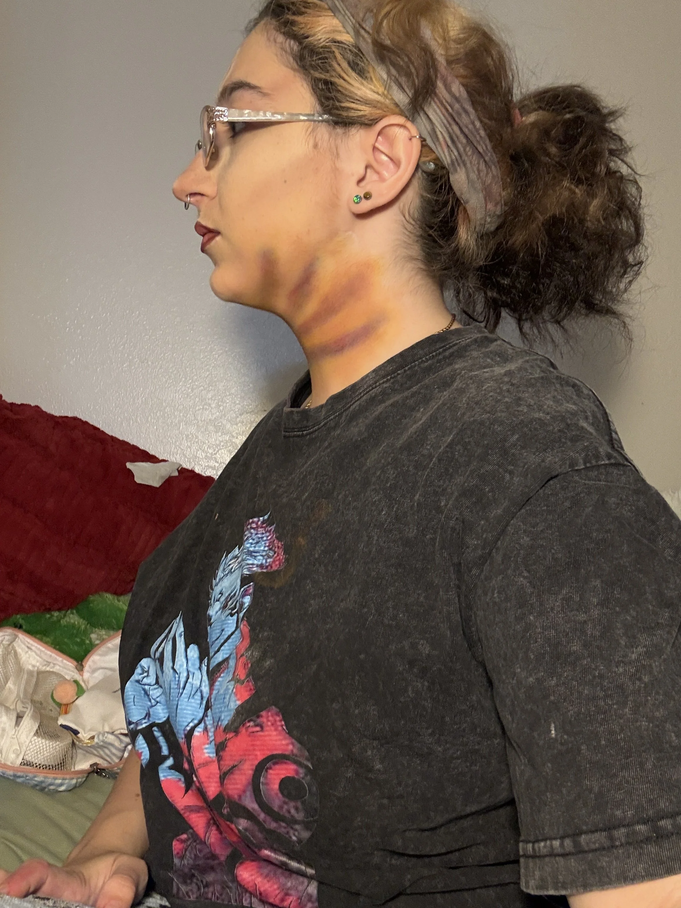 Bruise 3.JPG