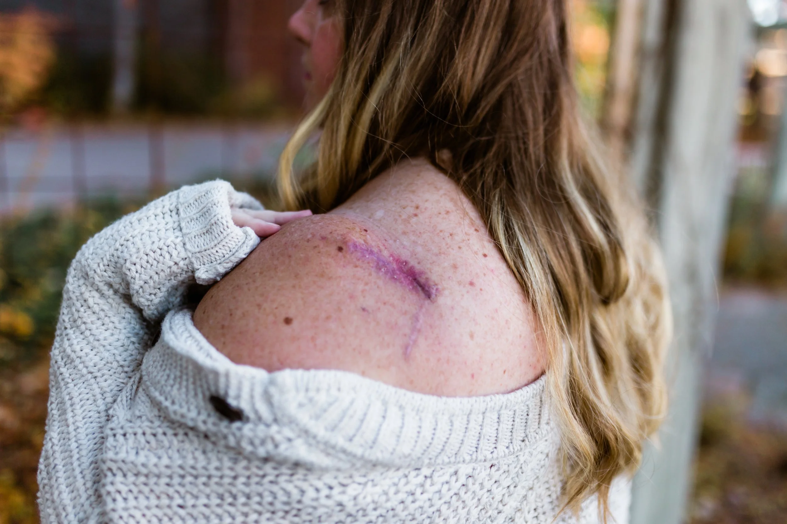 Jenn Patrice Schultz, a young woman with blonde hair wearing a light gray knitted sweater has a healed scar and purple bruise on her shoulder from her surgery to remove cancer.