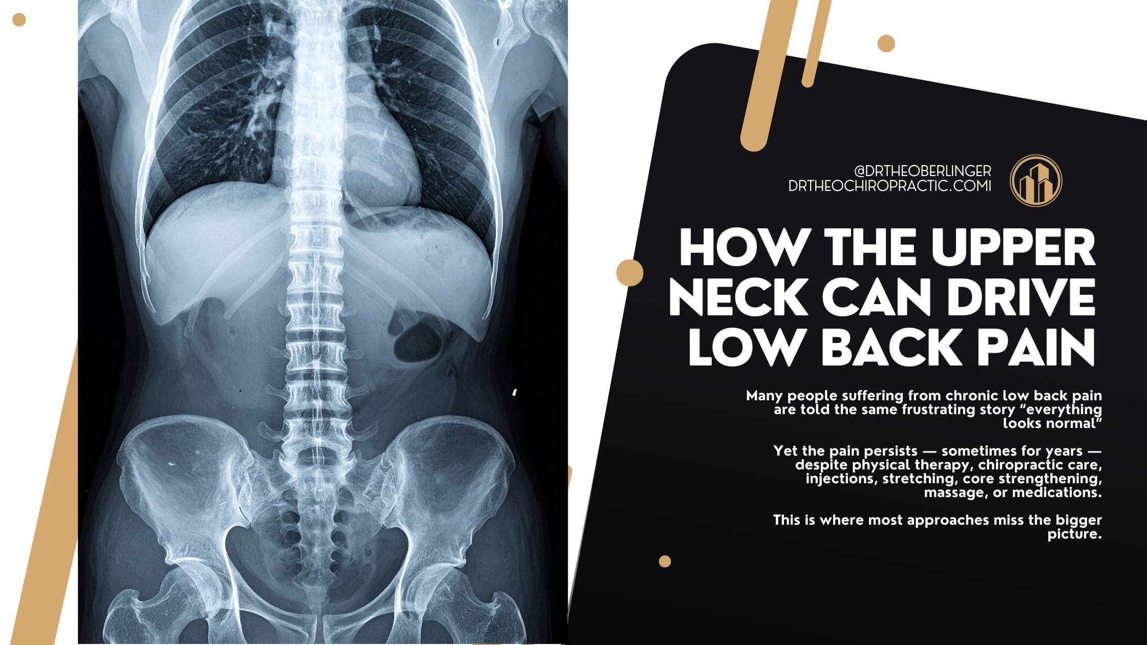 How The Upper Cervical Spine Can Drive Low Back Pain Even When Imaging Looks “Normal”