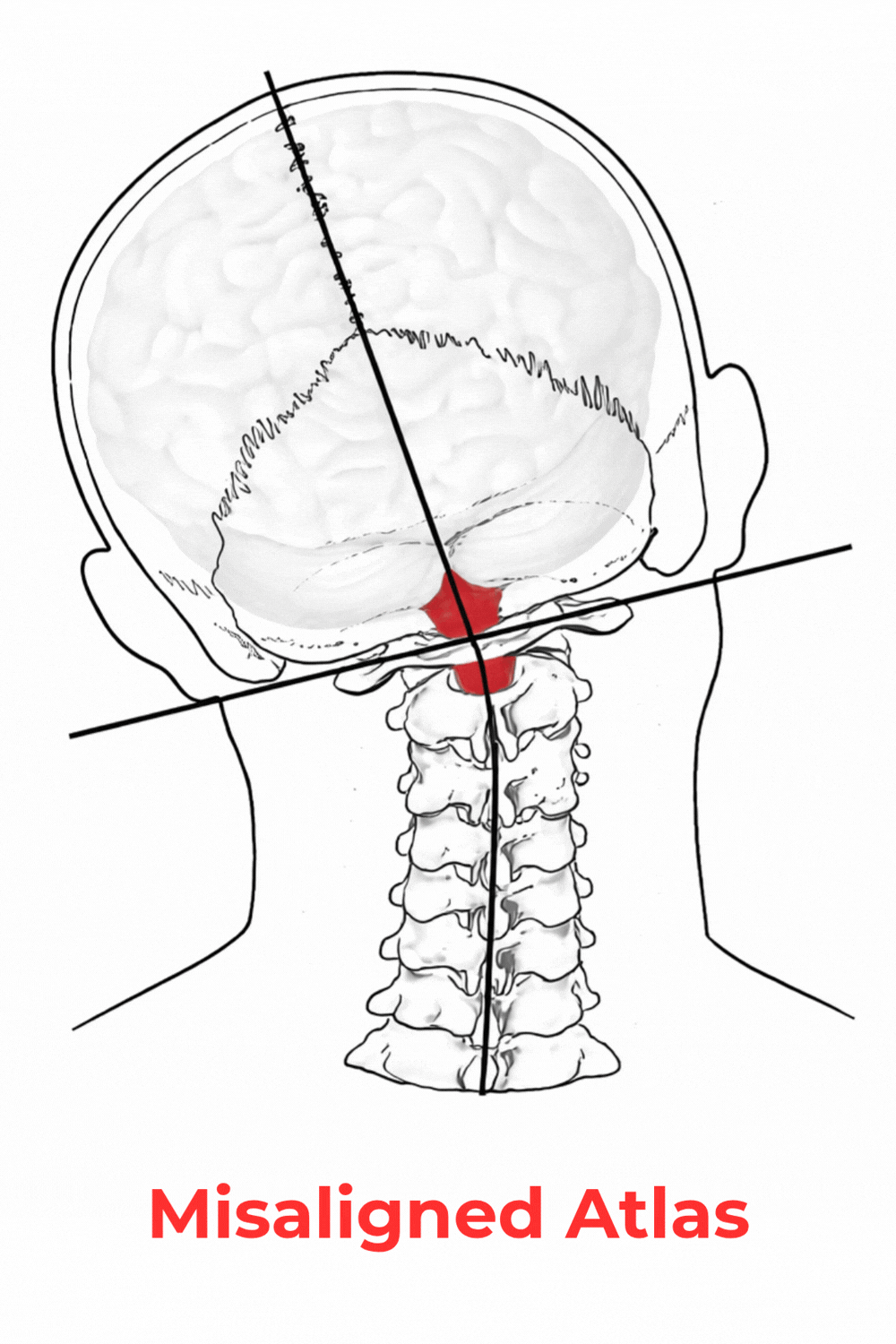 Illustration of a human skull with a misaligned atlas vertebra highlighted in red, showing head and neck from a back view with anatomical lines and a label at the bottom saying 'Misaligned Atlas'.