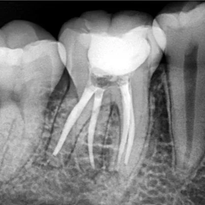 Radix Entomolaris: Manejo Endodóntico