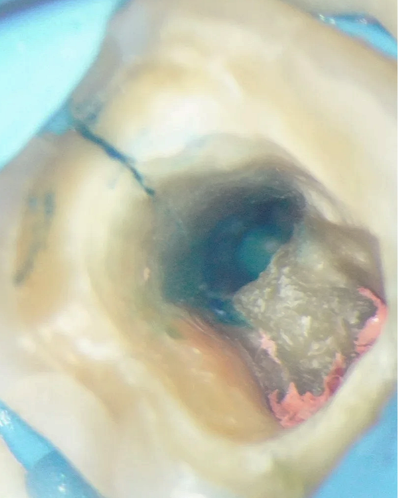 Físura radicular ¿Está todo perdido?: Manejo quirúrgico endorestaurador