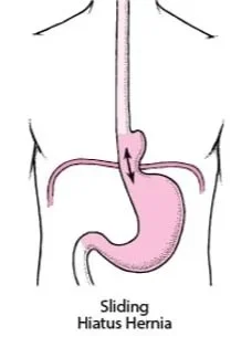 Illustration of a sliding hiatus hernia showing the stomach protruding through the esophageal hiatus in the diaphragm.