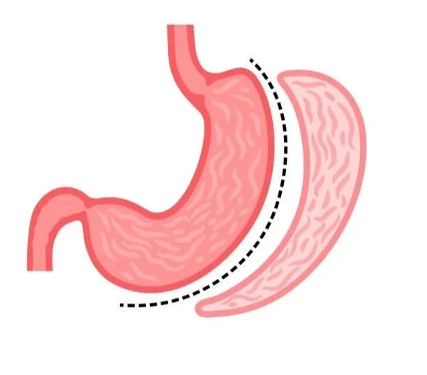 Illustration of a stomach with a dotted line showing a potential surgical cut, alongside a separate section of stomach or tissue.