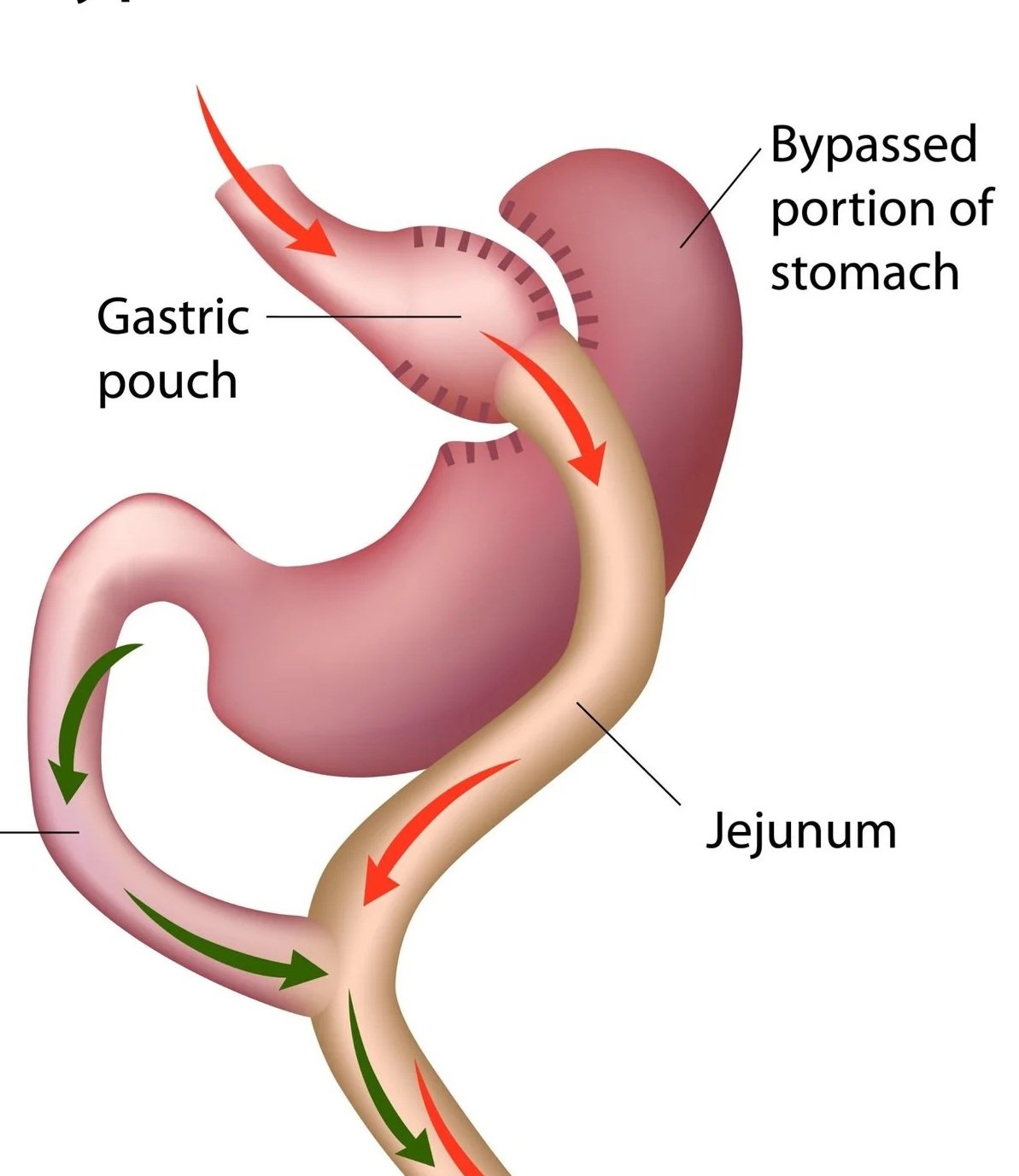 Diagram of the human stomach showing the gastric pouch, bypassed portion of the stomach, and the path of food through the stomach and small intestine.