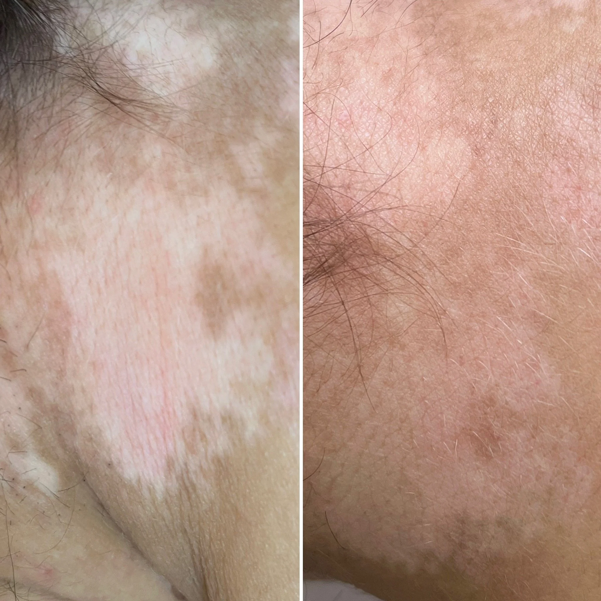 Vitiligo camouflage - tonal pigment integration