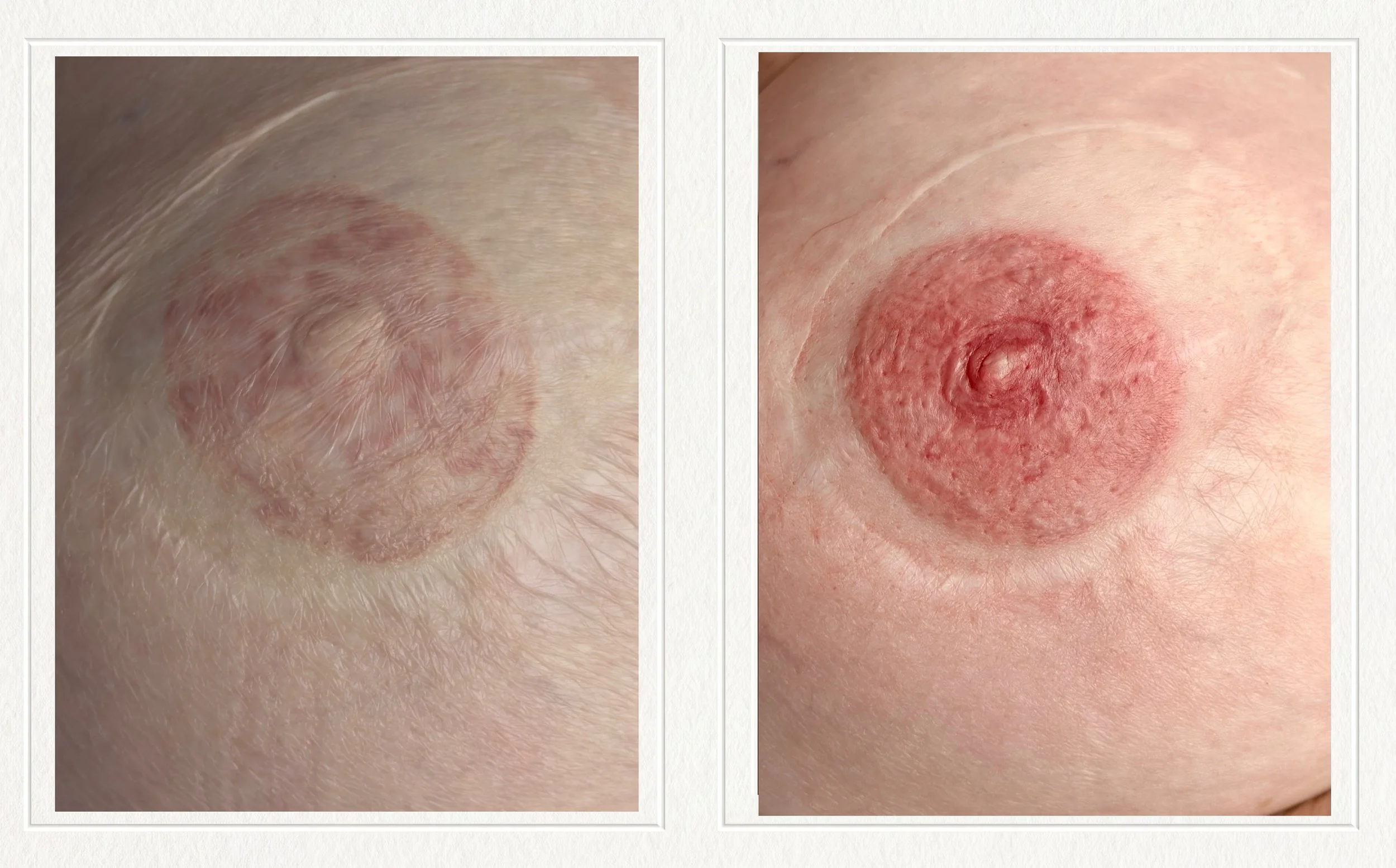 Areola restoration, London