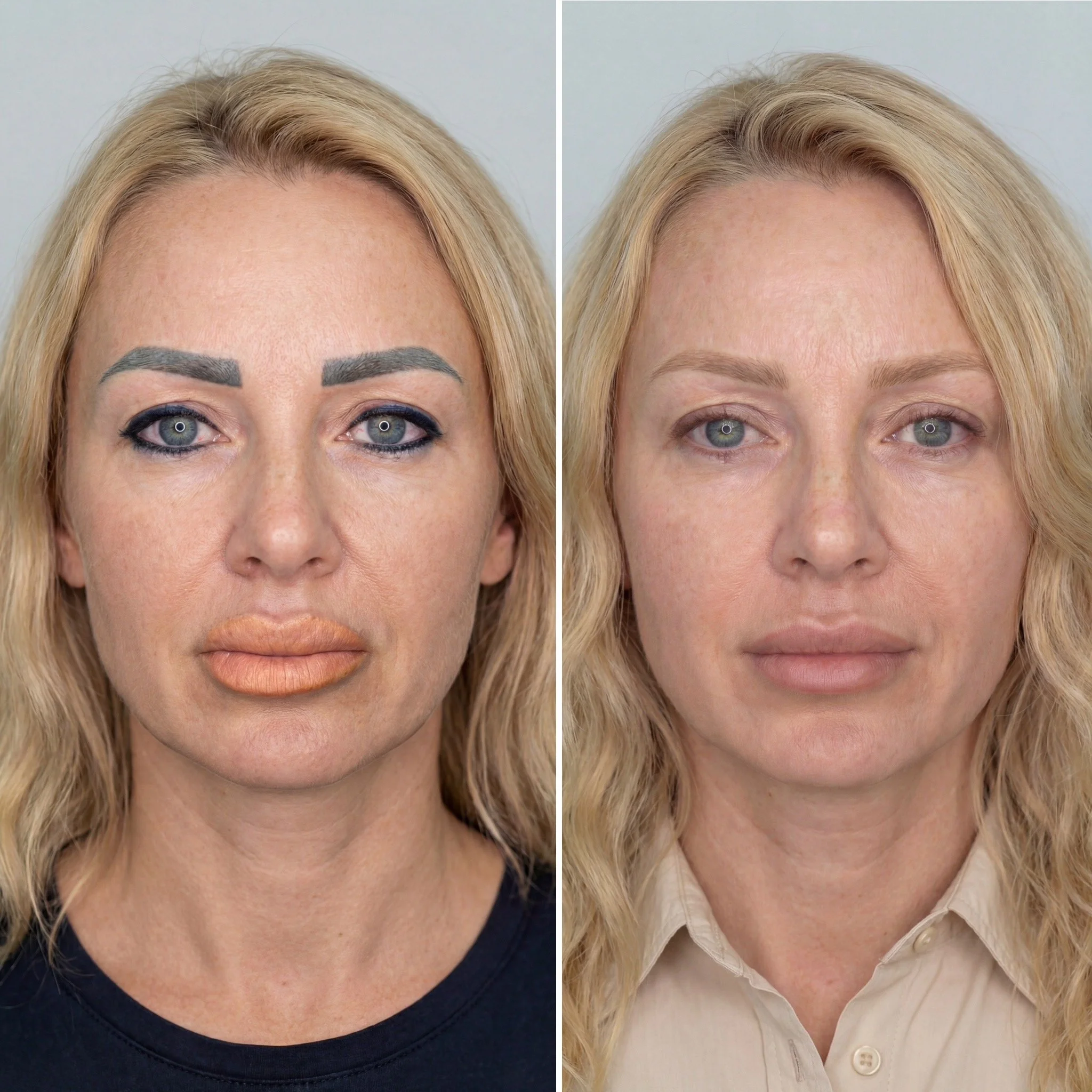 How to Remove Unwanted Permanent Makeup: Laser vs Remover