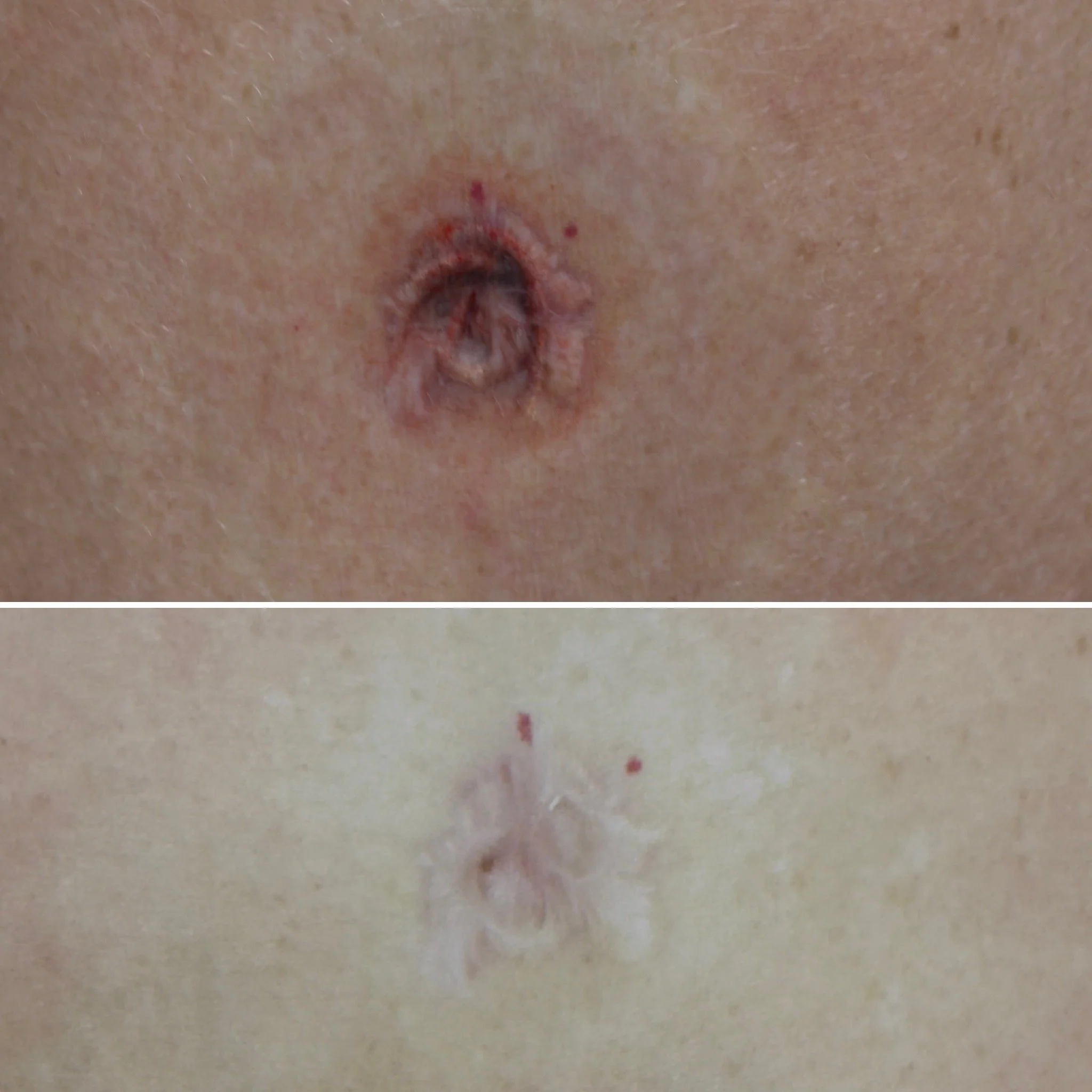navel reconstruction