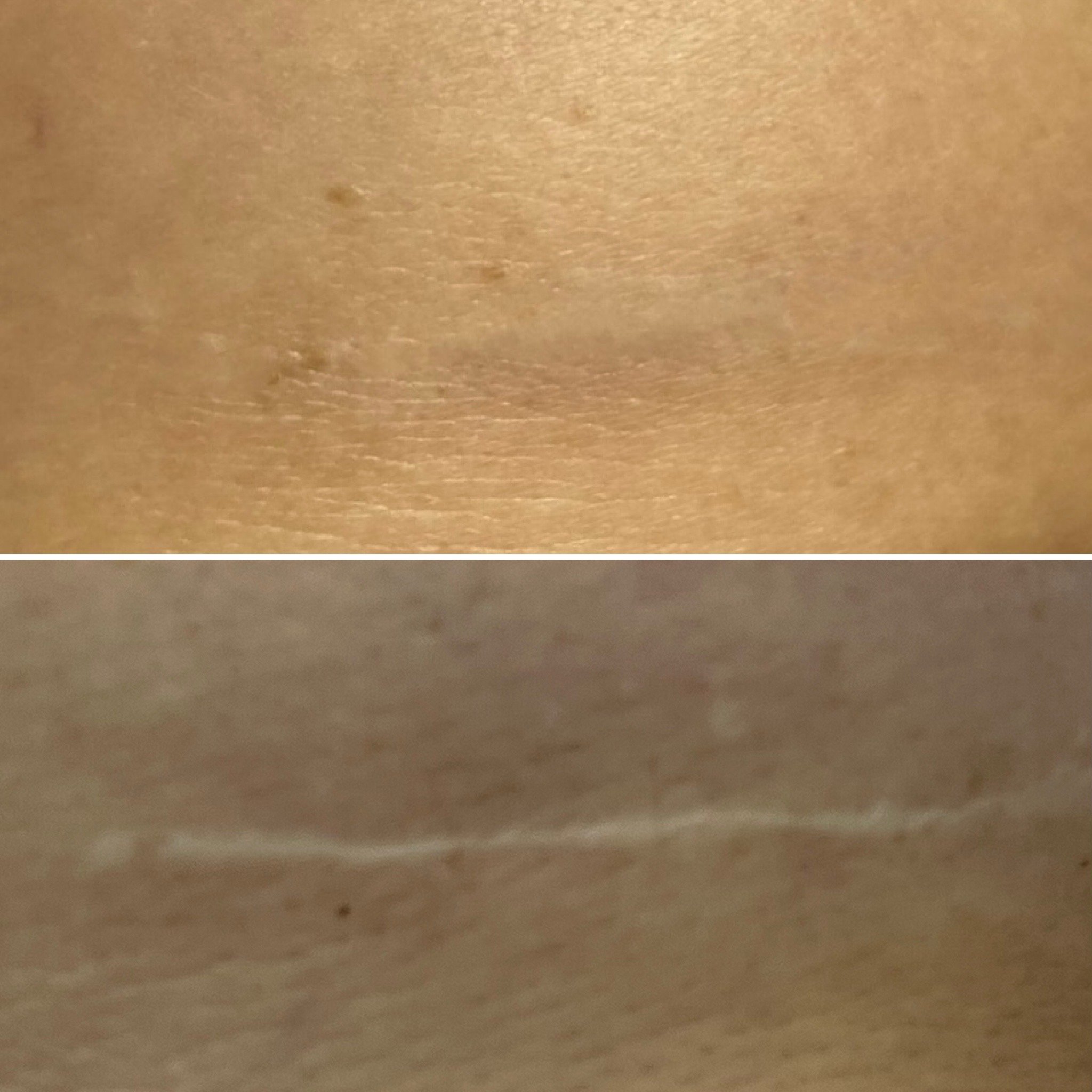 Post-surgery  scar camouflage