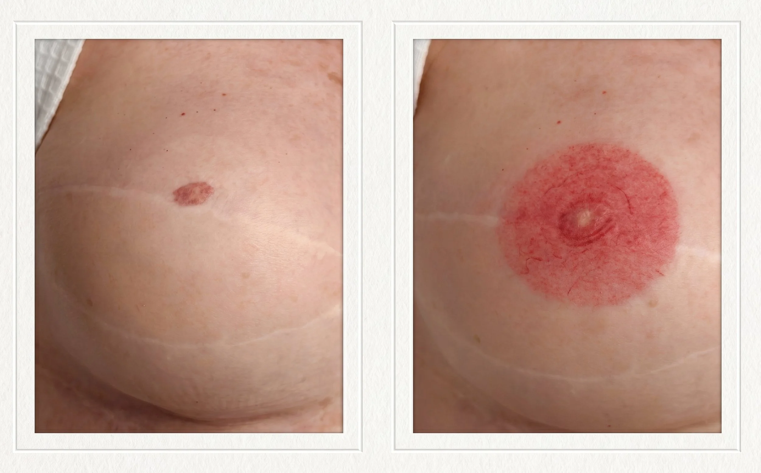 Areola reconstruction after mastectomy