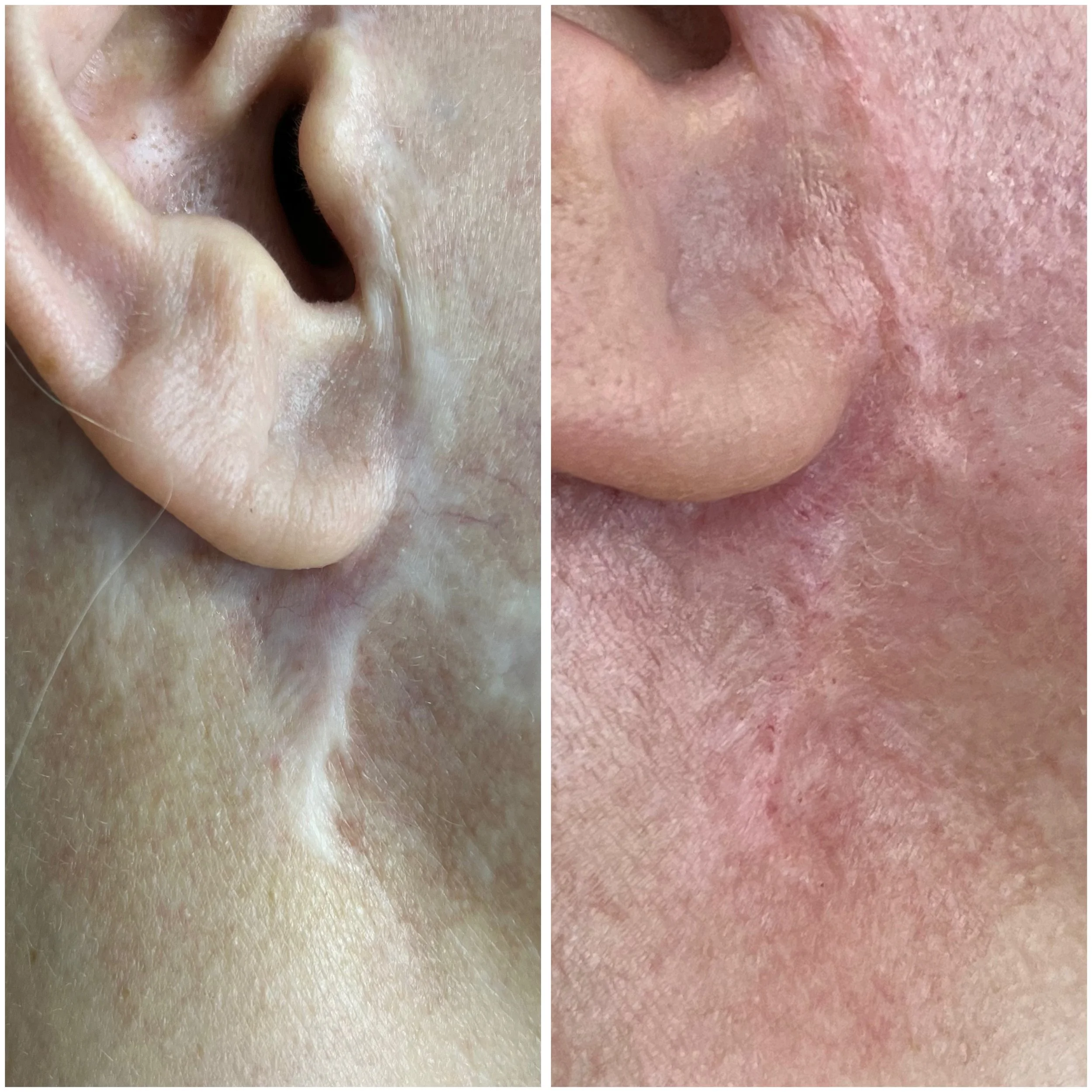 Skin-tone micropicmentation blending  a pale scar into the surrounding skin