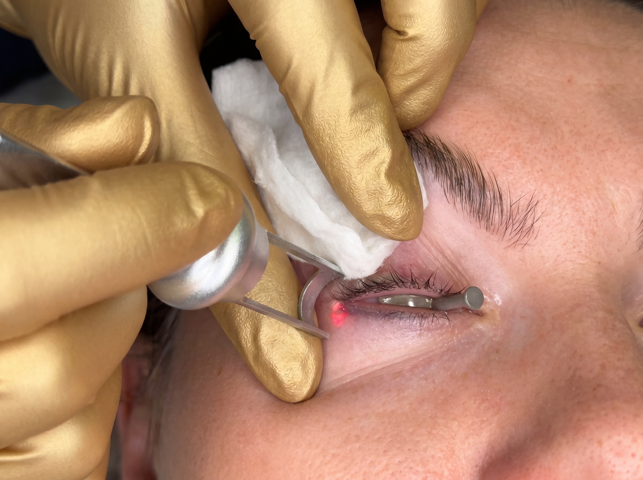 Laser removal of permanent eyeliner with a protective corneal eye shield in place