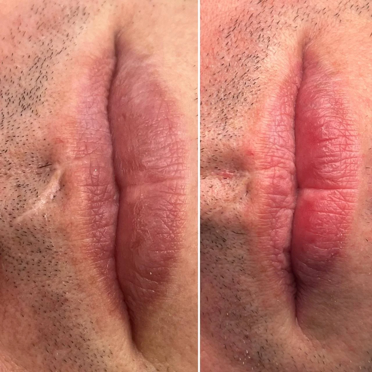 Post-trauma scar camouflage above the lip with upper lip symmetry correction