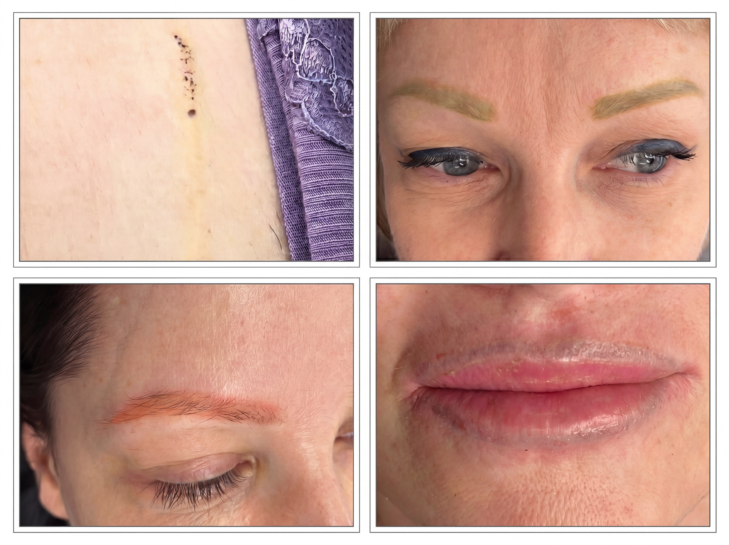 Pigment colour inversion in permanent makeup brows and lips laser removal