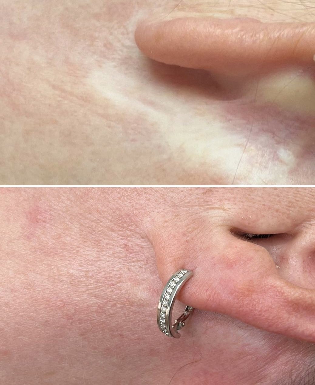 Before and after scar camouflage, London