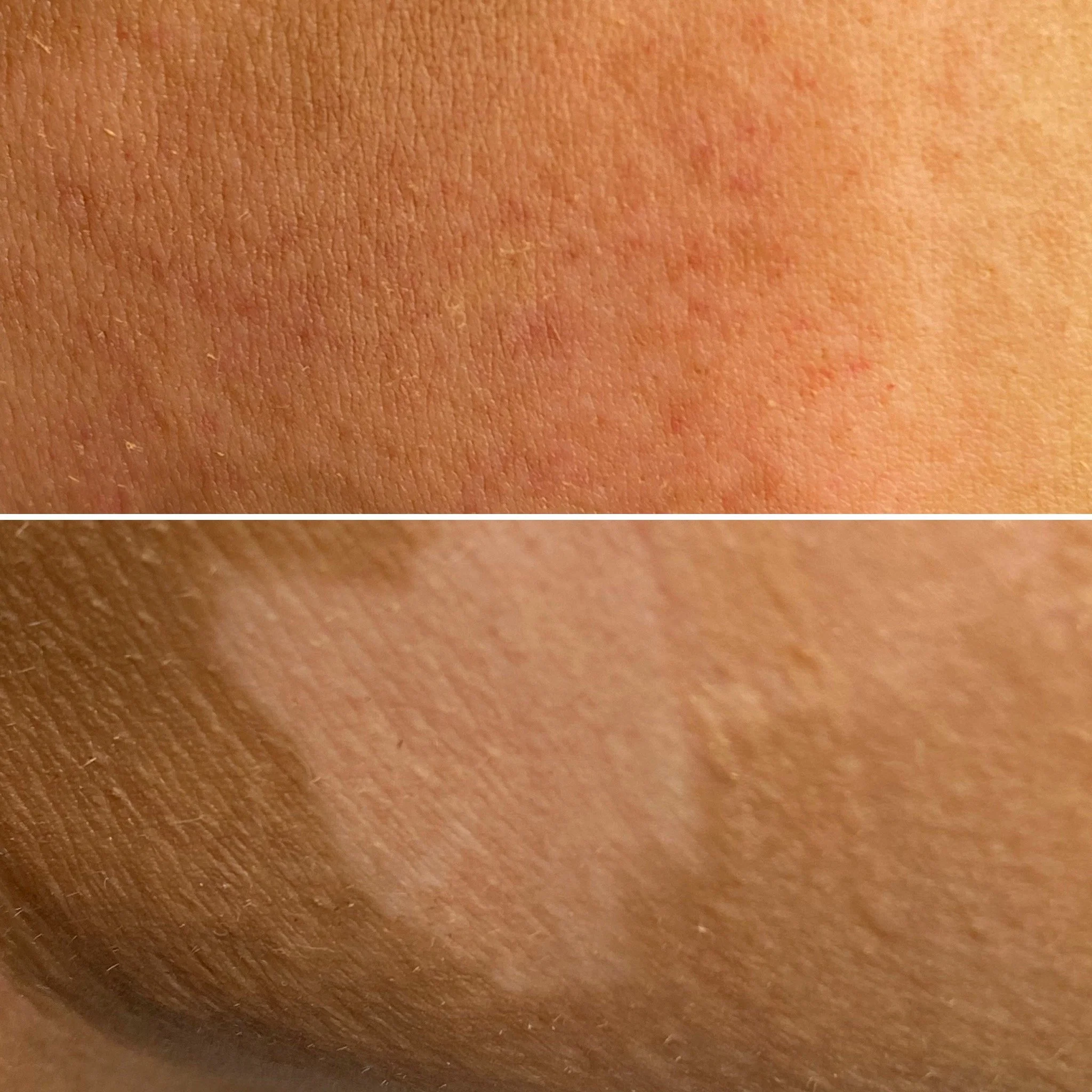Vitiligo camouflage - tonal pigment integration
