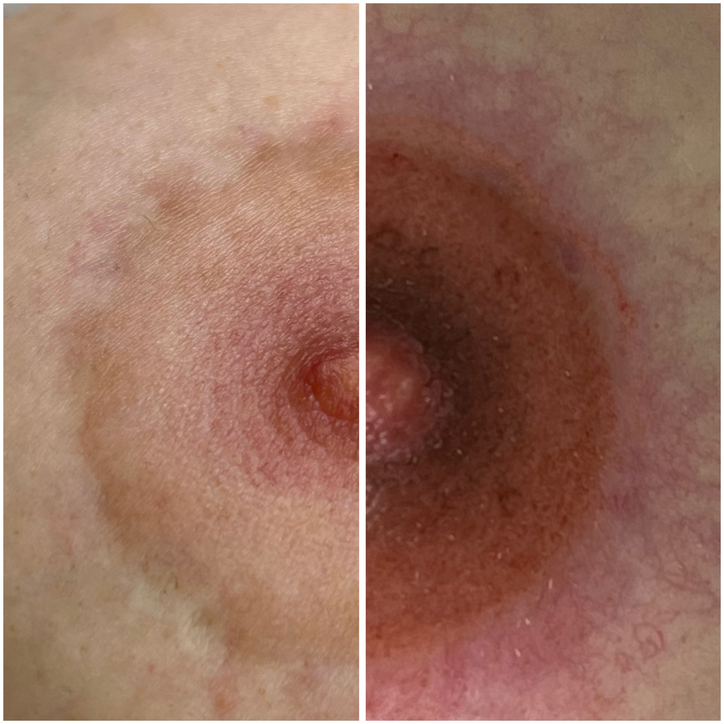 Post-breast lift scar camouflage with nipple and areola reconstruction