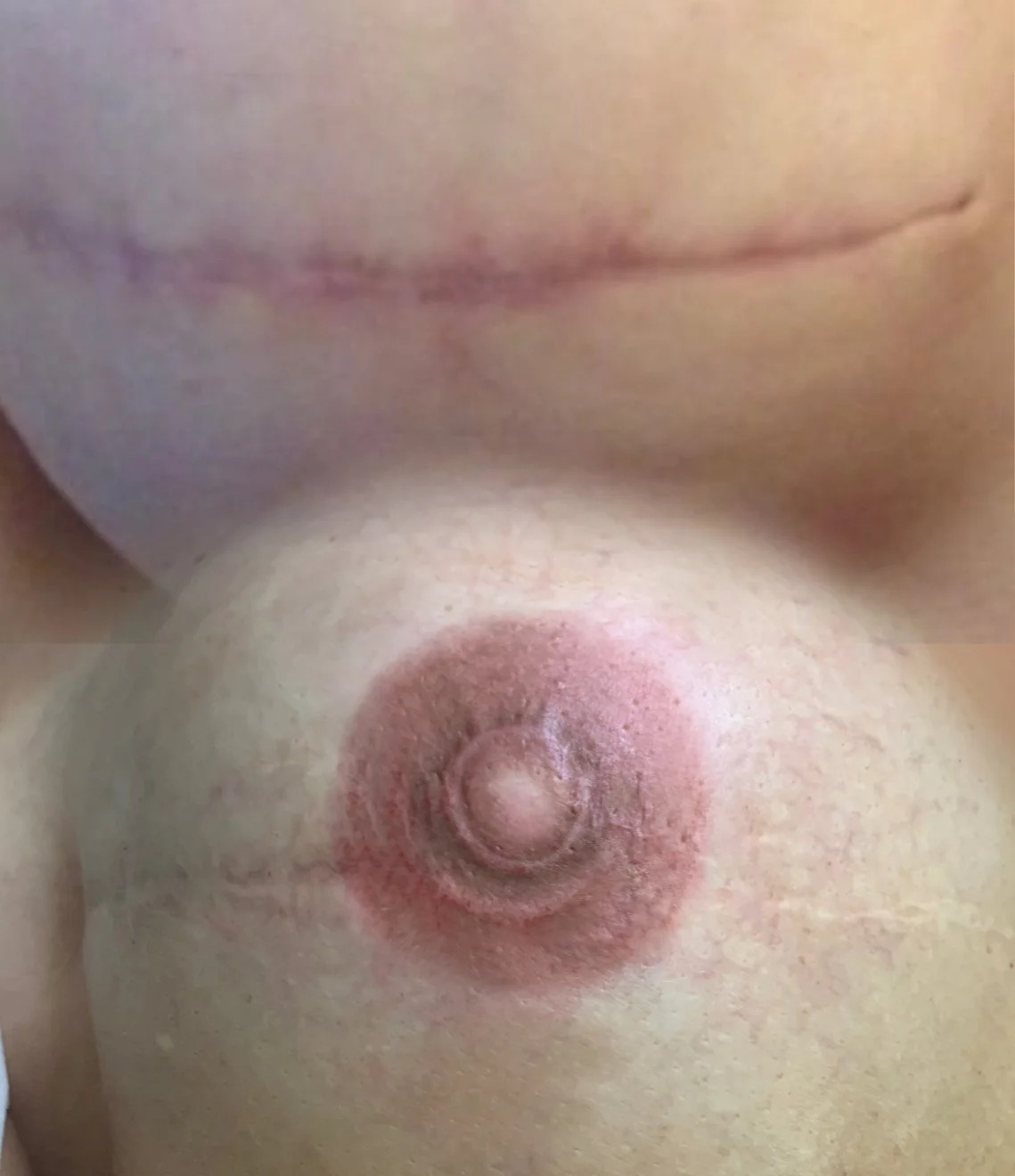 3D areola restoration after breast cancer surgery healed result
