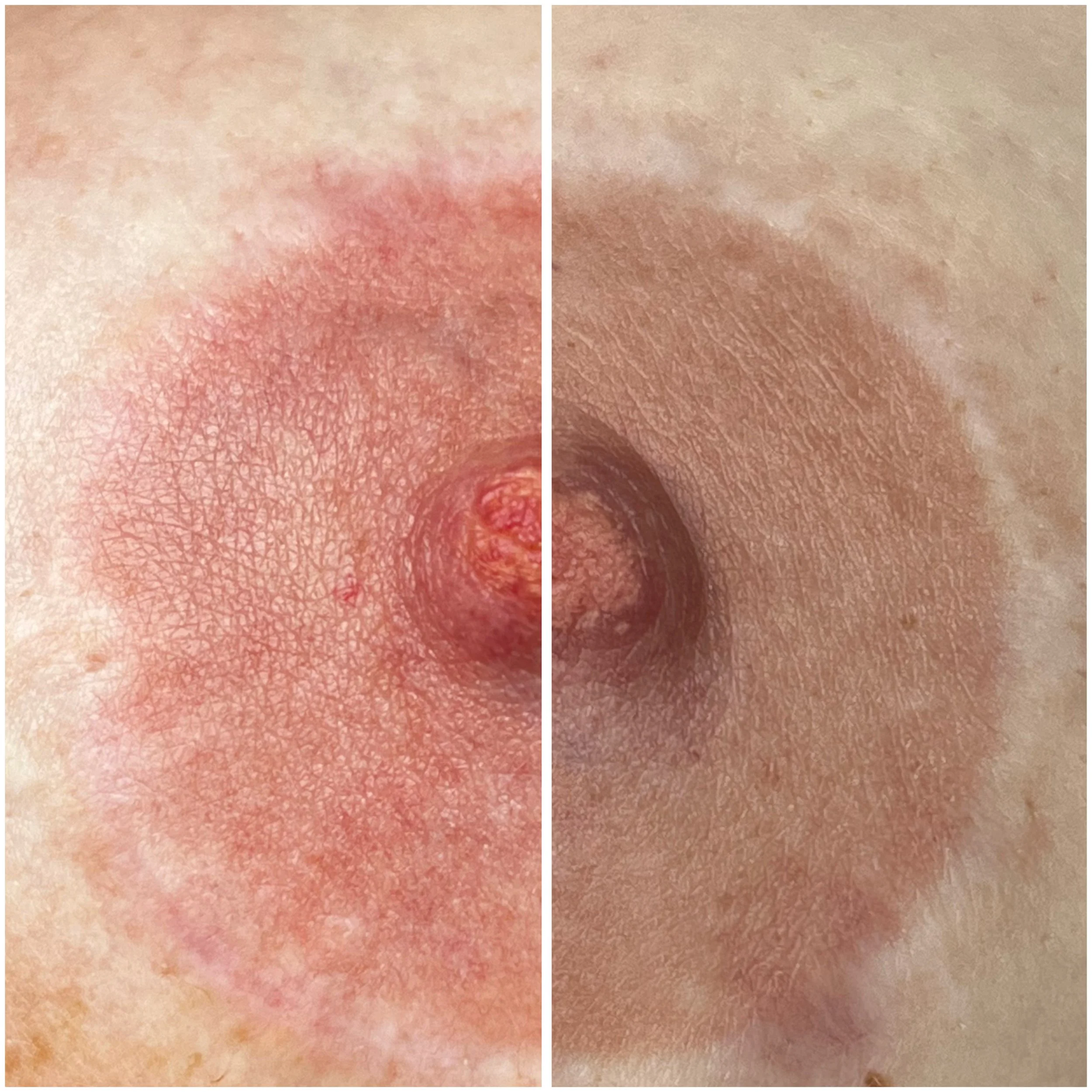 Post-breast lift scar camouflage with nipple and areola reconstruction