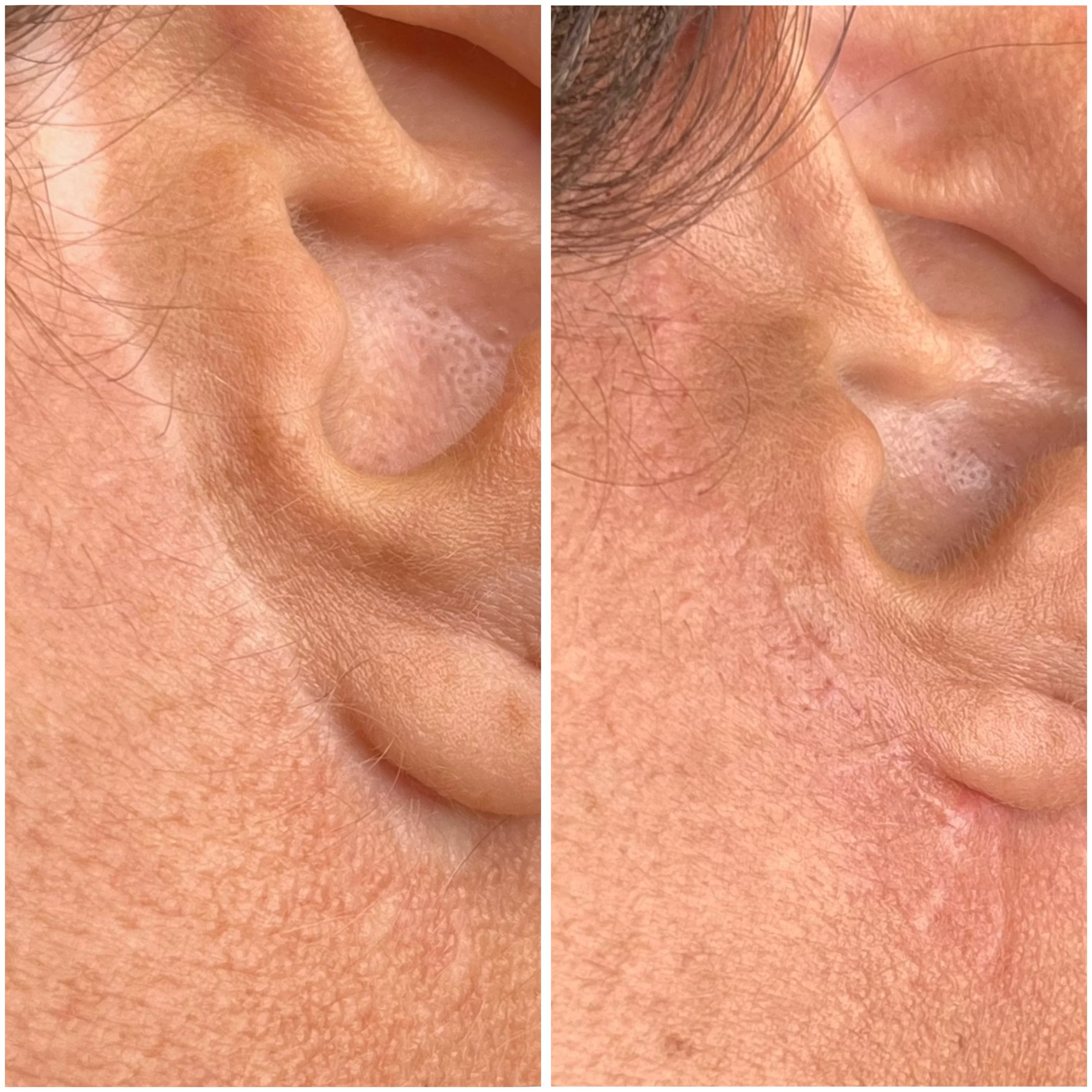 Post-facelift scar camouflage