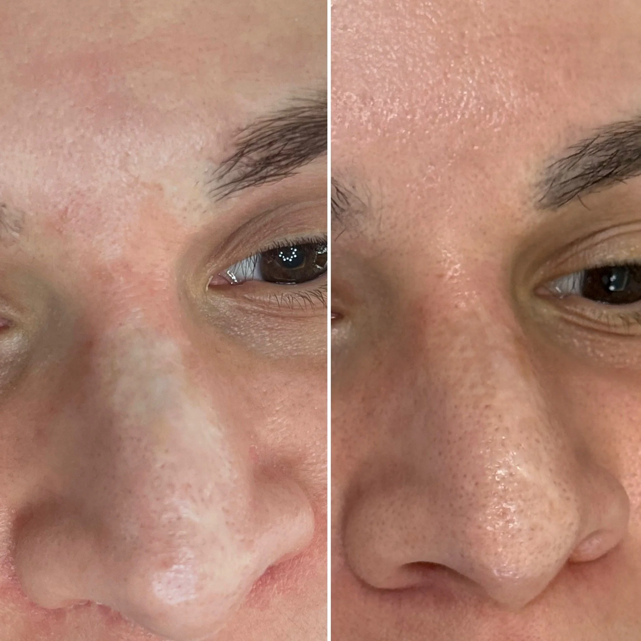 before and after scar camouflage, London