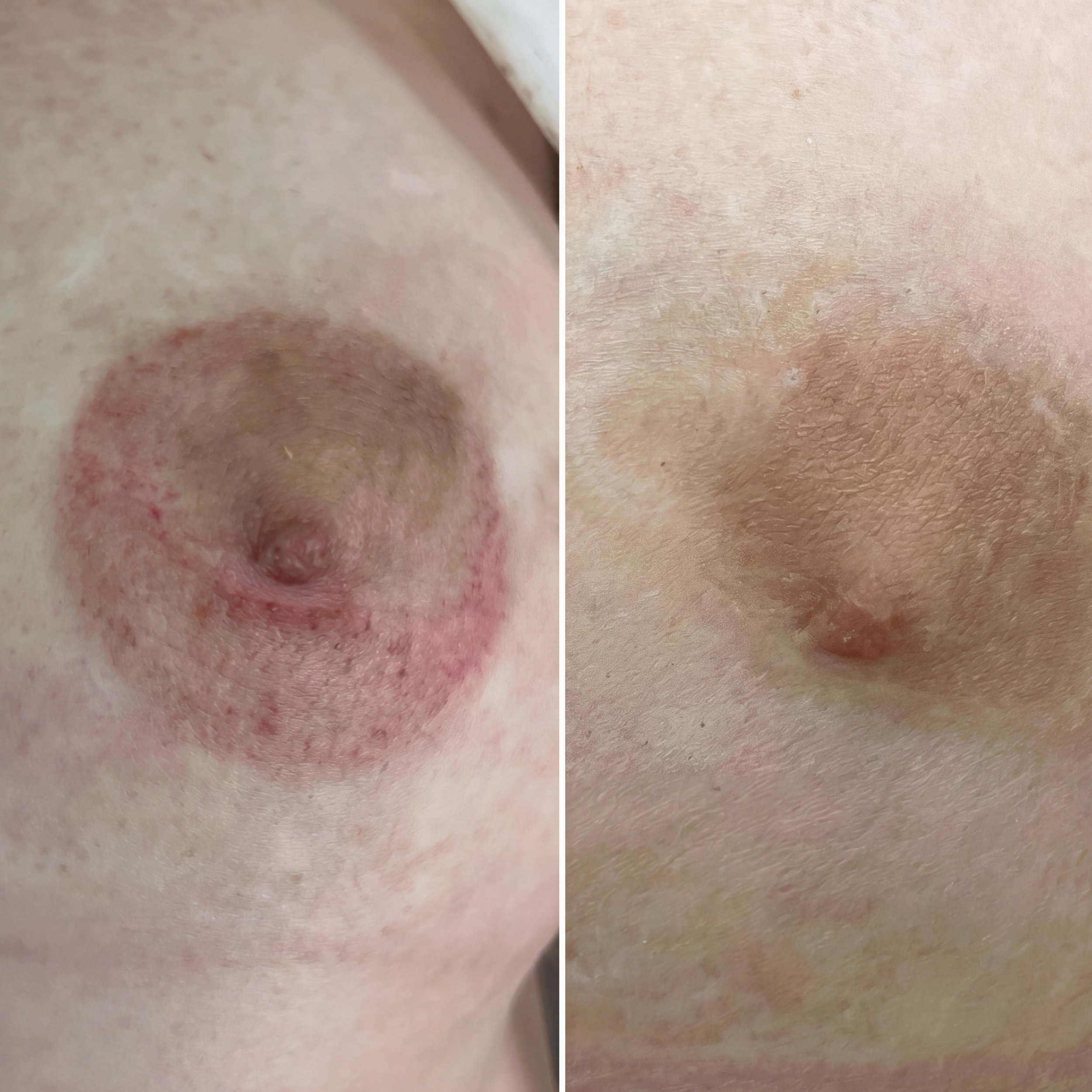 3D areola restoration after breast cancer surgery