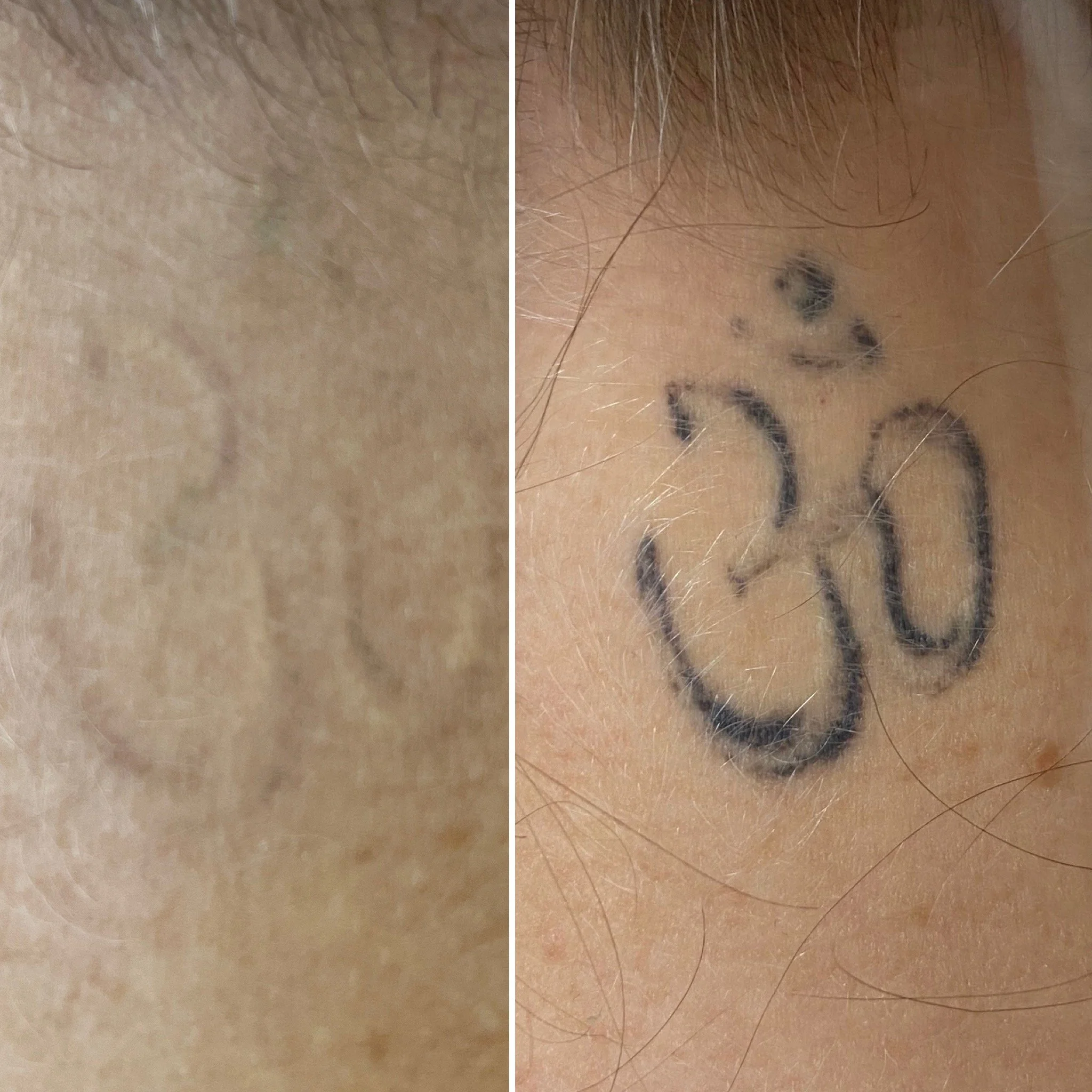 Tattoo removal using Rejuvi Tattoo Remover method