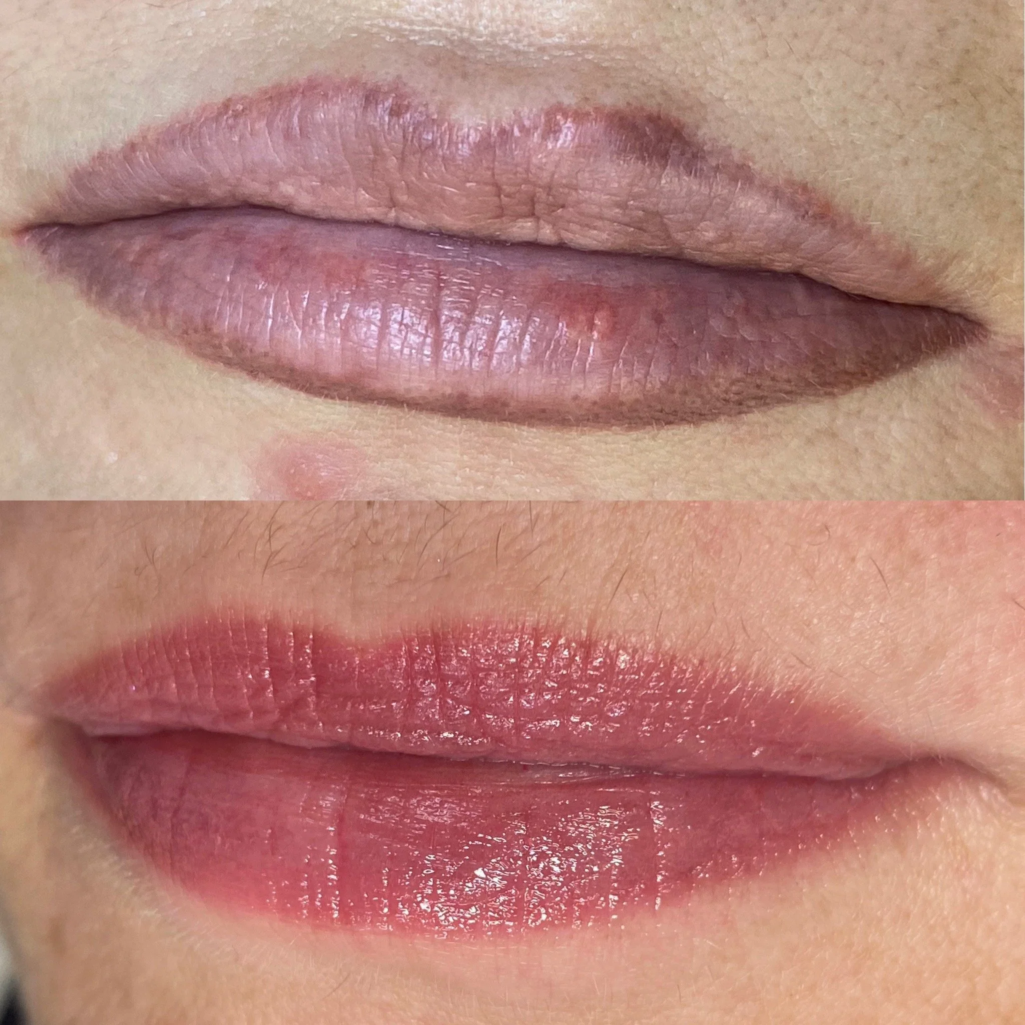 Unwanted permanent makeup removed with Rejuvi Tattoo Removal and then redesigned - tailored to the client's features and current aesthetic.