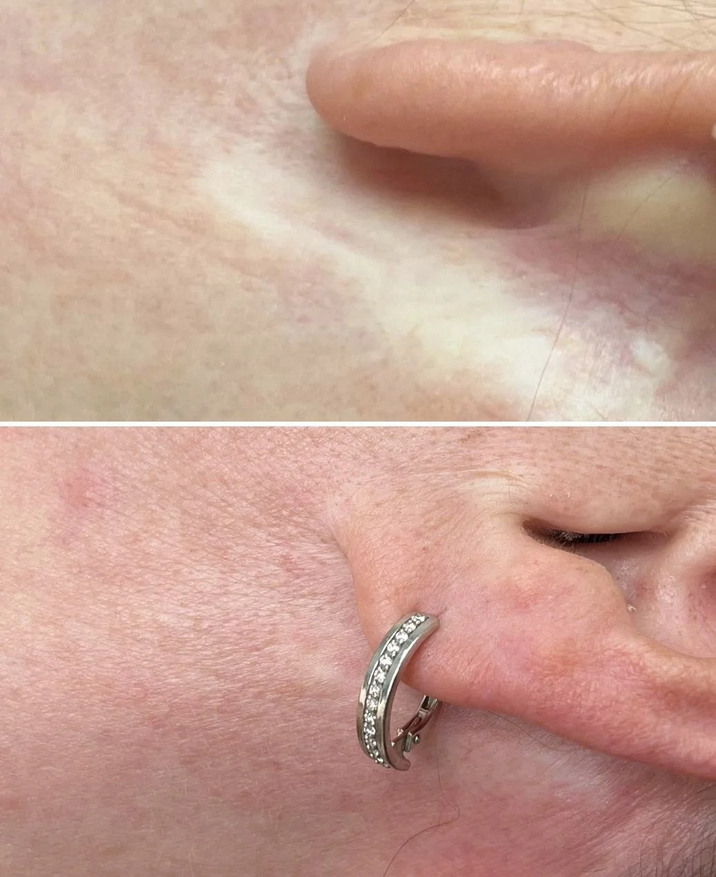 Post-facelift scar camouflage