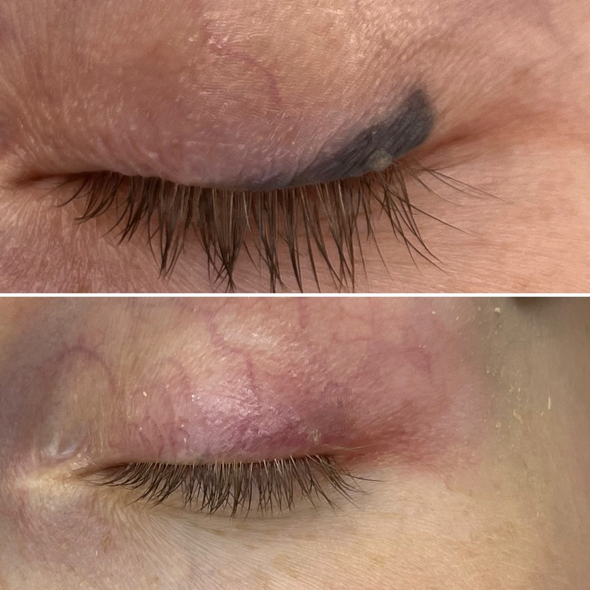 Outdated permanent makeup removed with Rejuvi Tattoo Removal