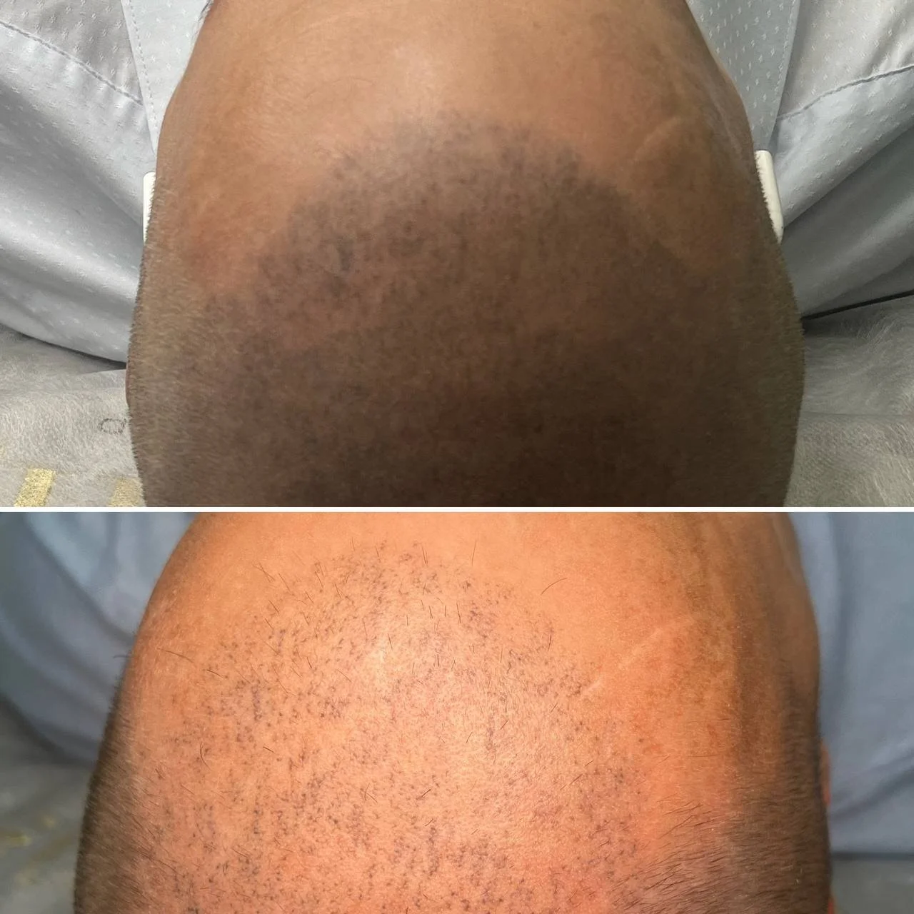 Scalp micropigmentation for hair loss and alopecia before and after London