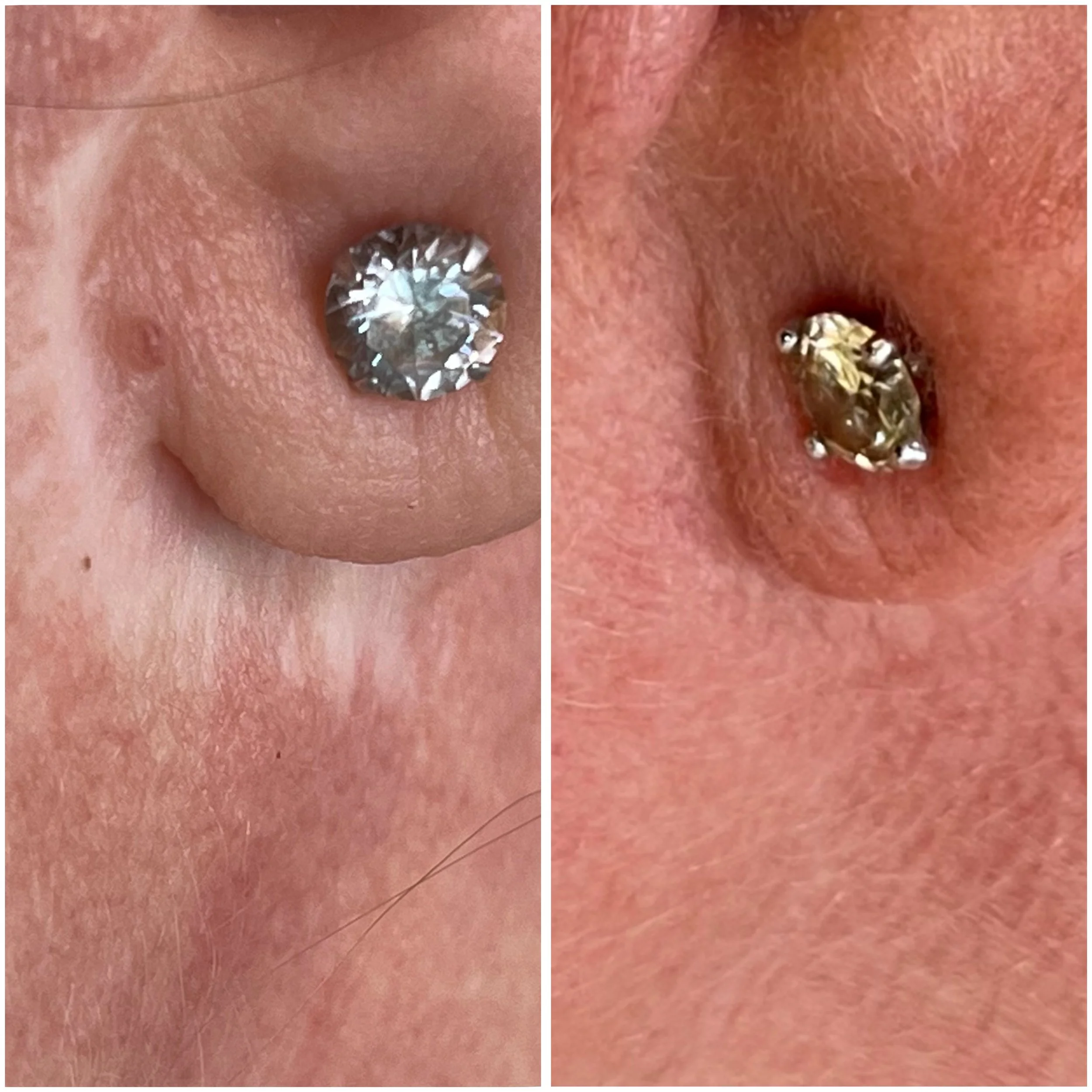 Post-facelift scar camouflage