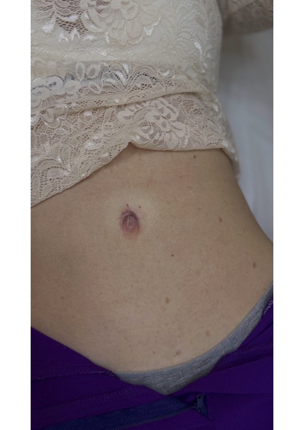 healed belly-button
