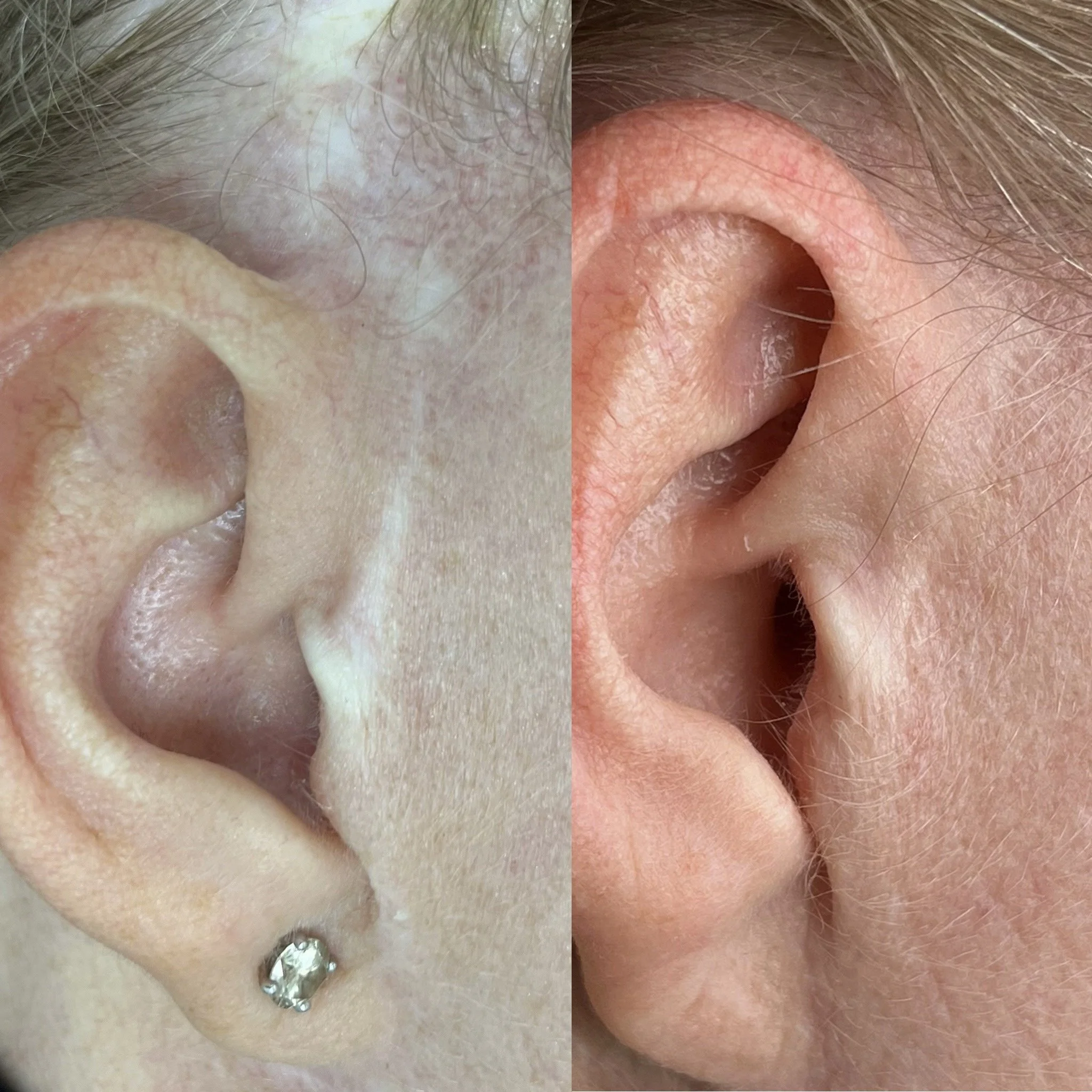 Post-facelift scar camouflage