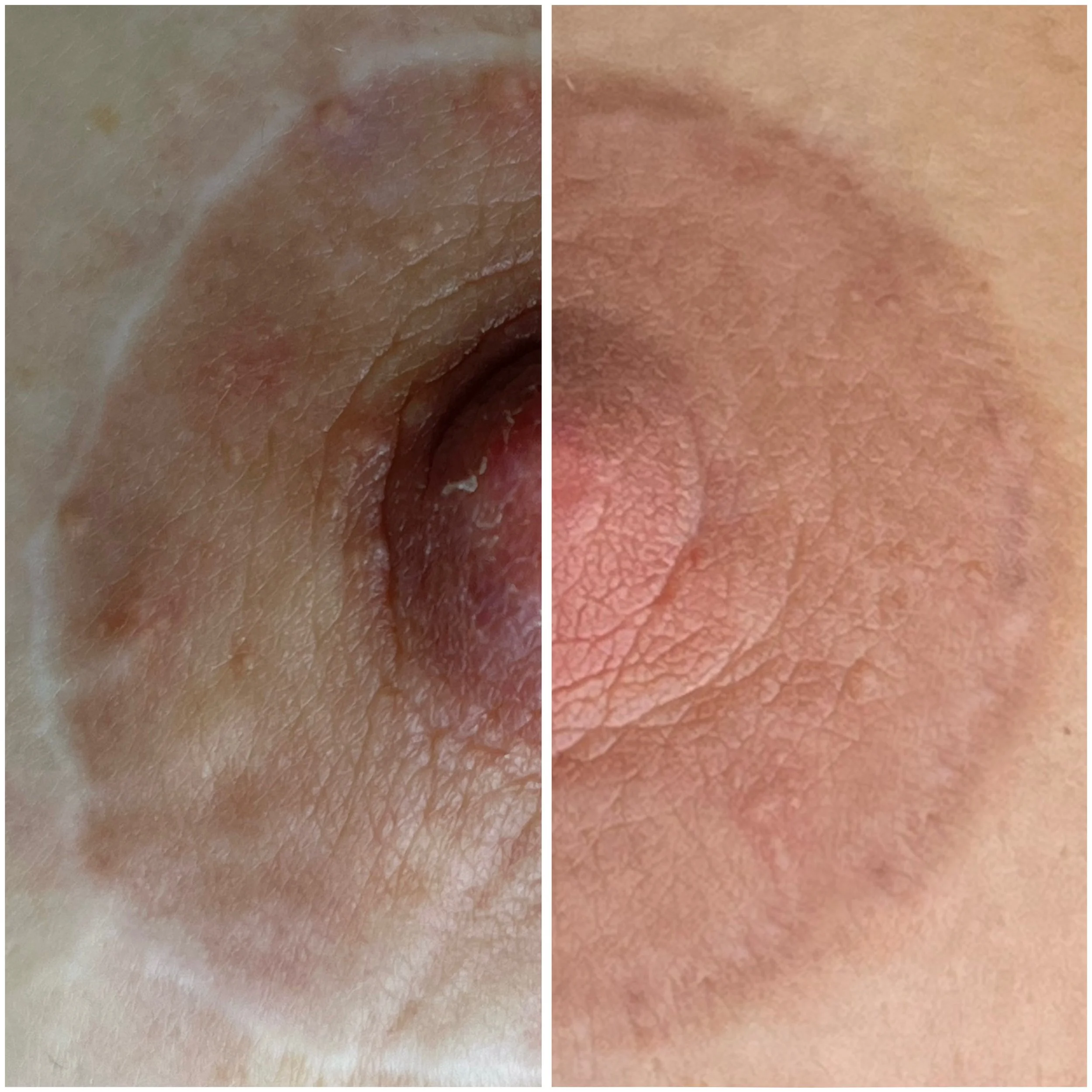 Post-breast lift scar camouflage with nipple and areola reconstruction