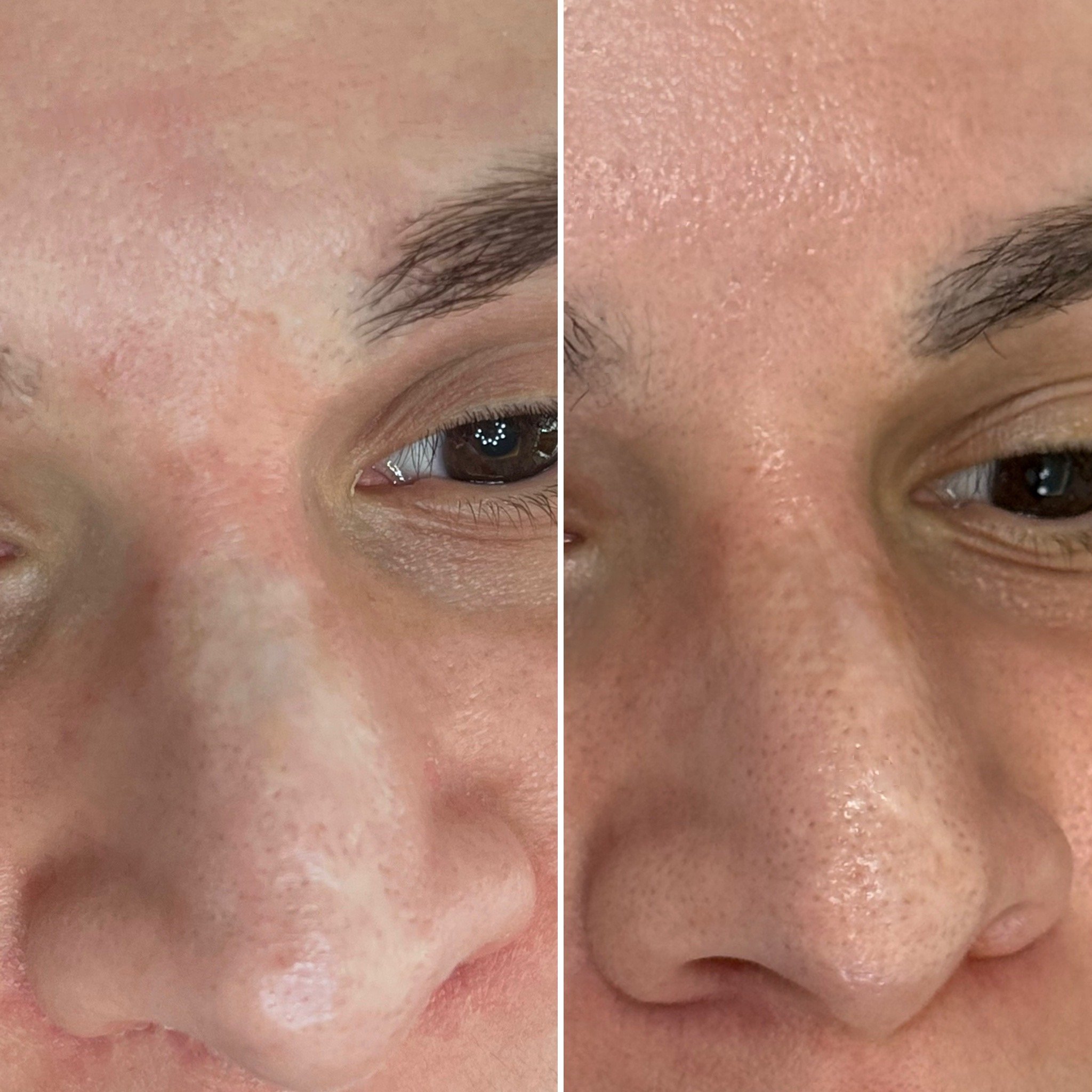 Scar camouflage before and after - paramedical  micropigmentation at AK Paramedical Studio London