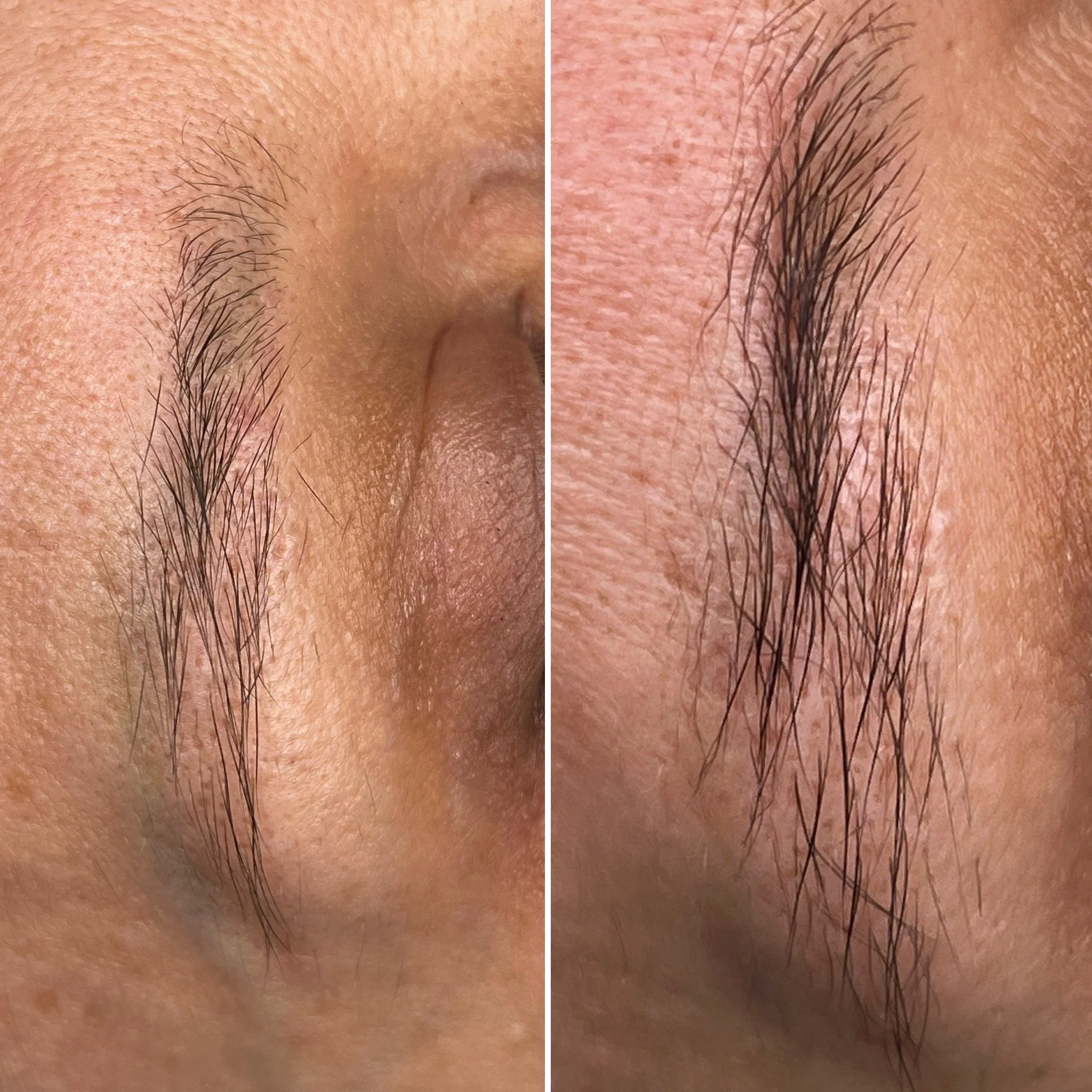 Outdated permanent makeup removed with Rejuvi Tattoo Removal