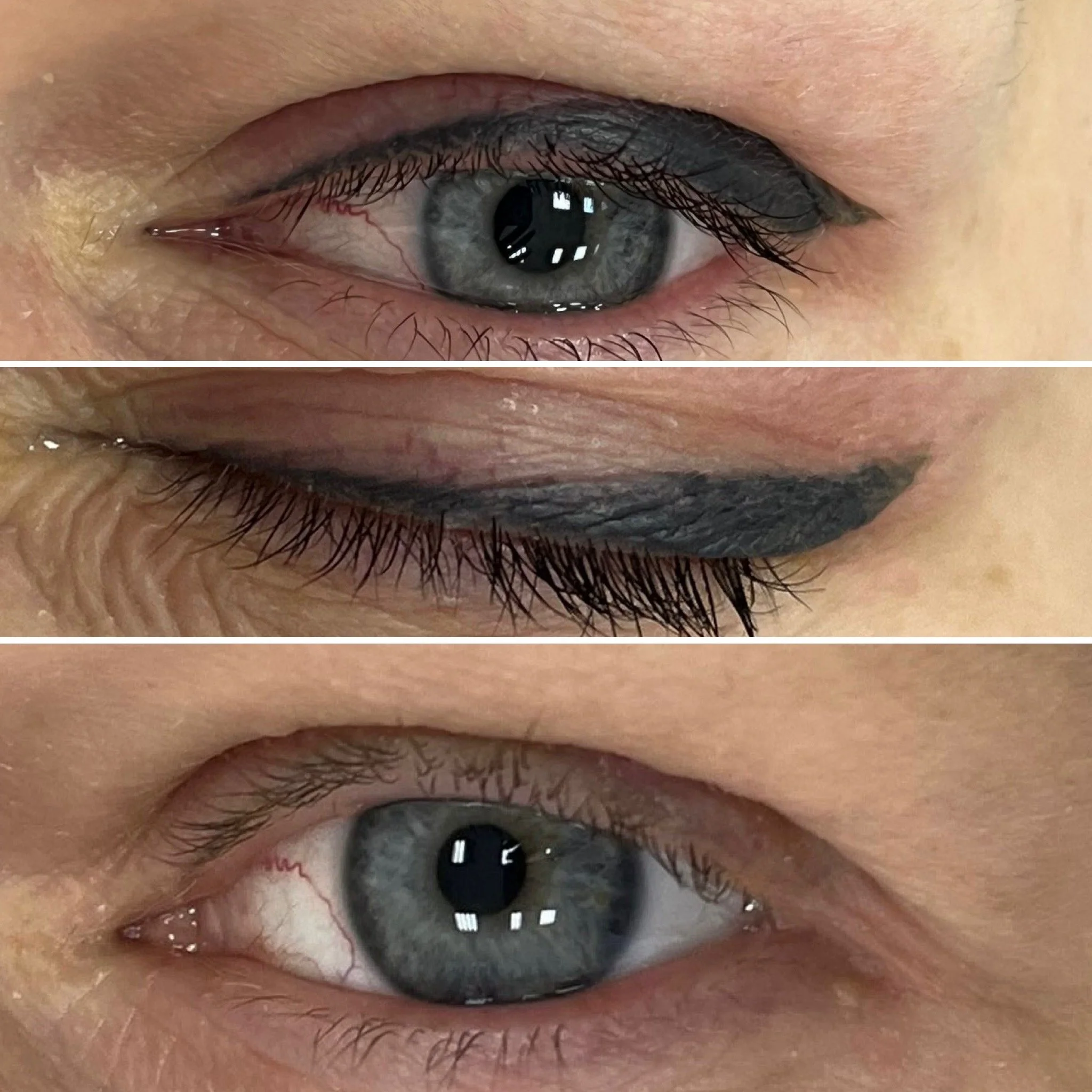 Outdated permanent makeup removed with Rejuvi Tattoo Removal