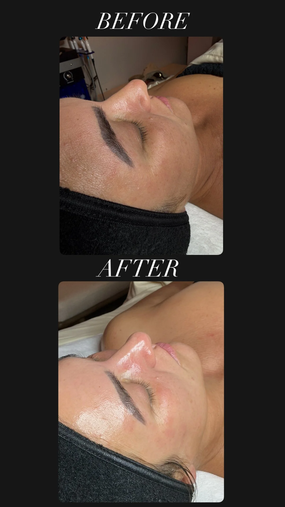 Microneedling before and after — real client results at Opulent Haus, Sarasota