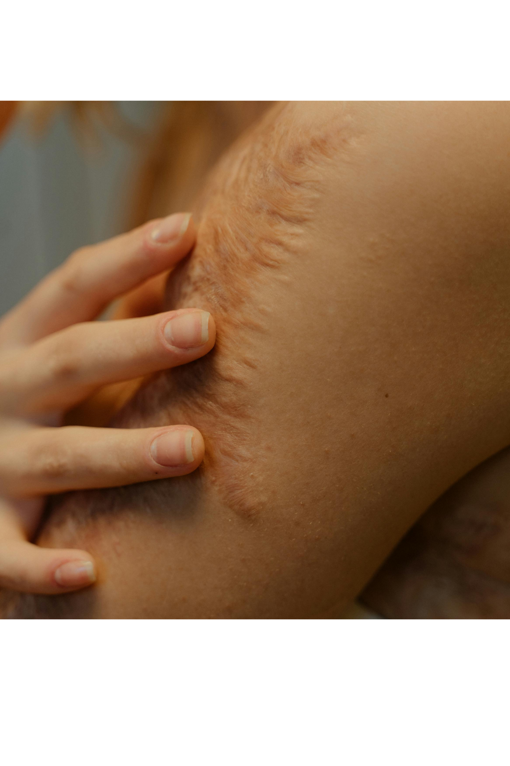 McLaughlin Scar Release Treatment: Why I Care So Much About Scar Work
