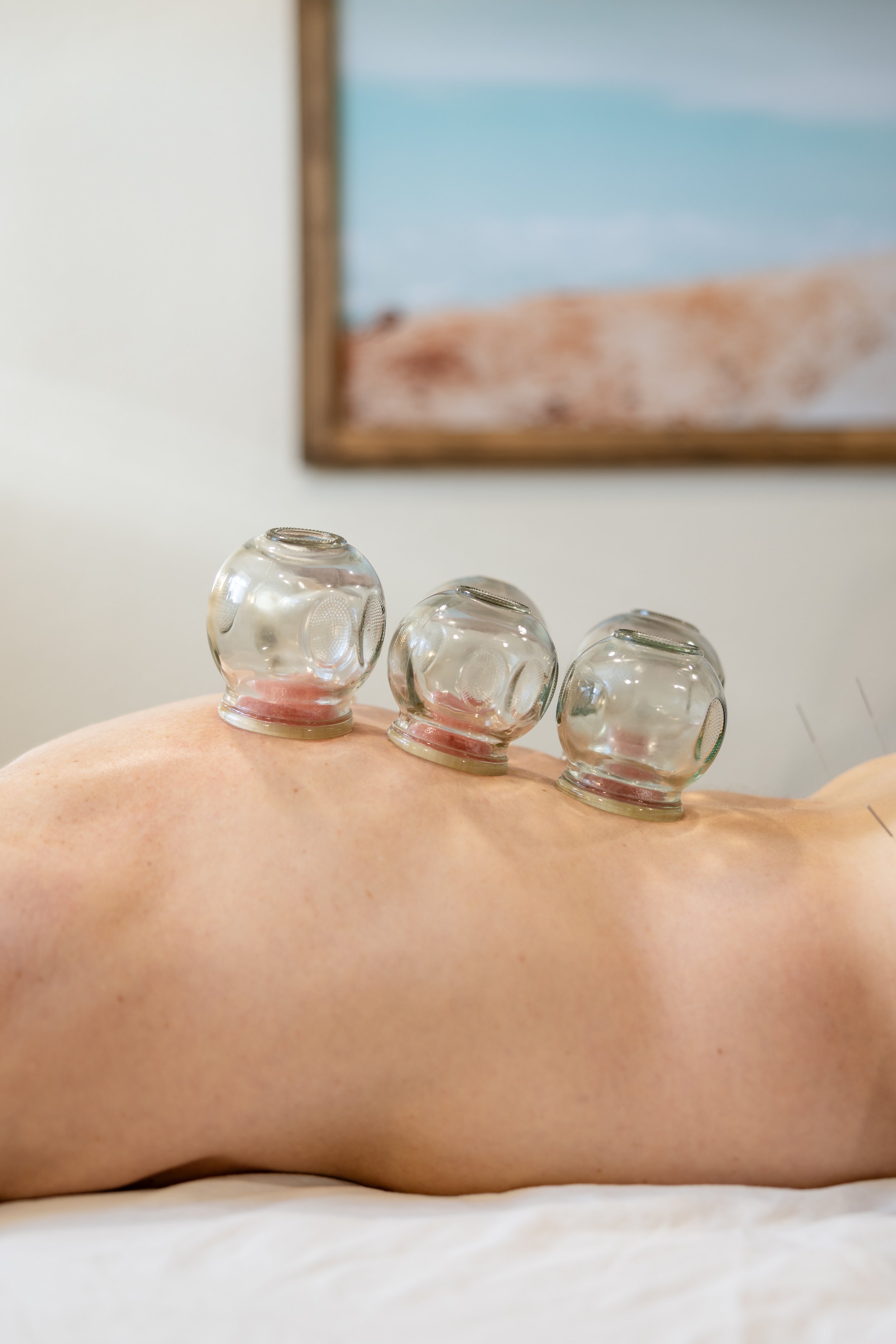 Acupuncture Moxa Cupping Chinese Eastern Medicine Casper Wyoming Needling