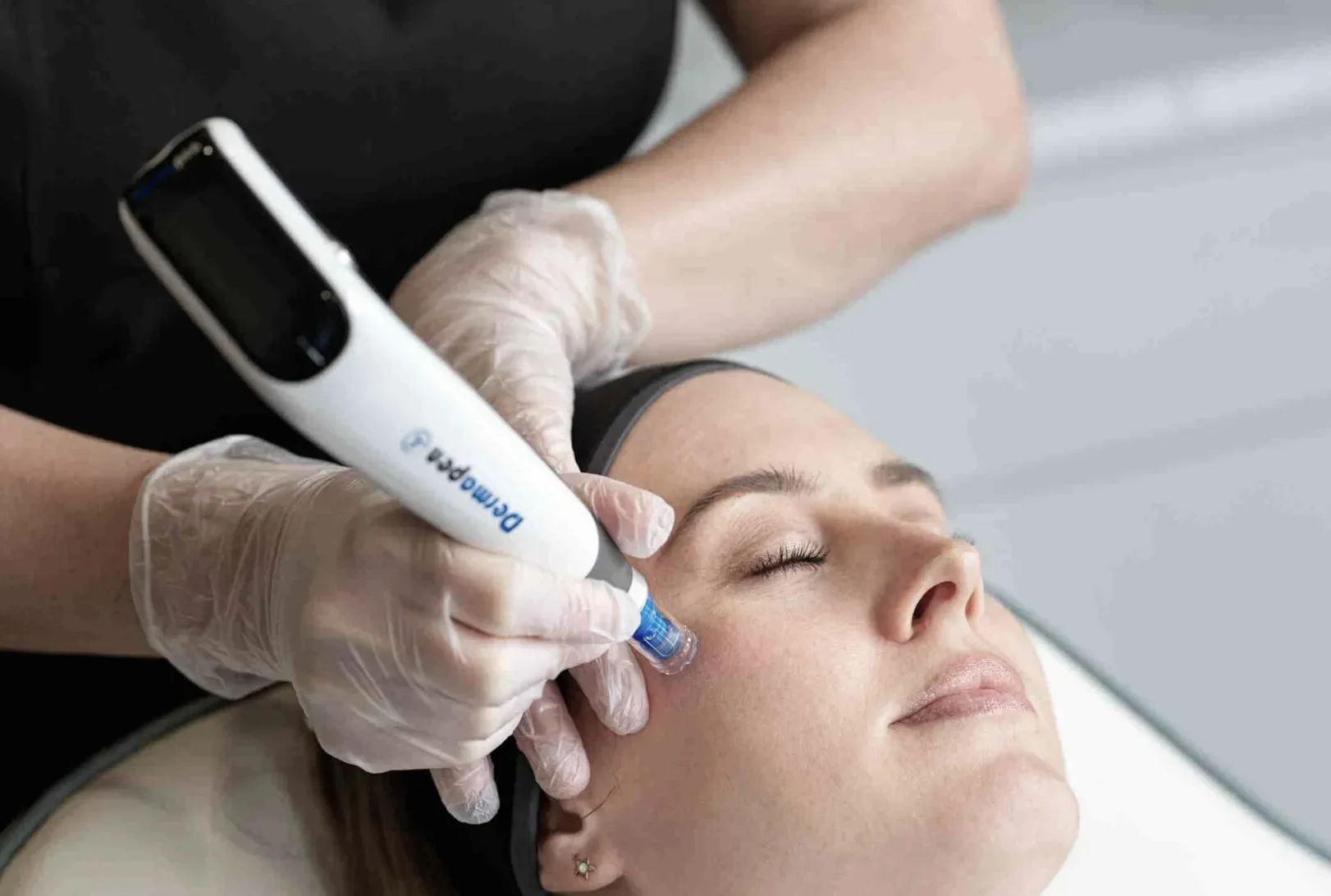 En person får en dermapen-behandling på ansiktet av en medicinsk specialist, som använder en Dermapen 4.
