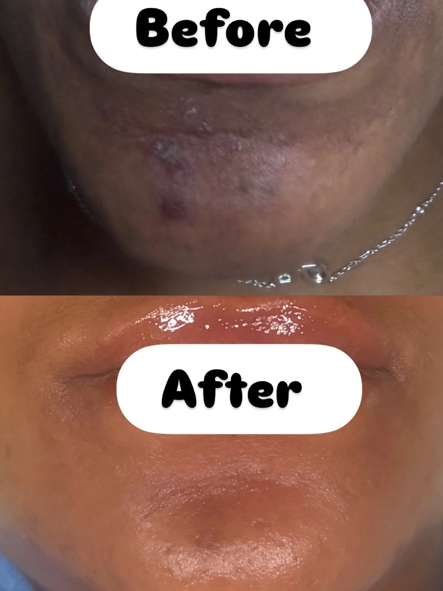 Fresh glow unlocked! Yes!! We do chemical peels! 
This client received our 5 Berry Rejuvenation Facial featuring the GlymedPlus antioxidant-rich 5 Berry Peel with 7% TCA, followed by a nourishing GlymedPlus Chocolate Enzyme Masque to gently exfoliate