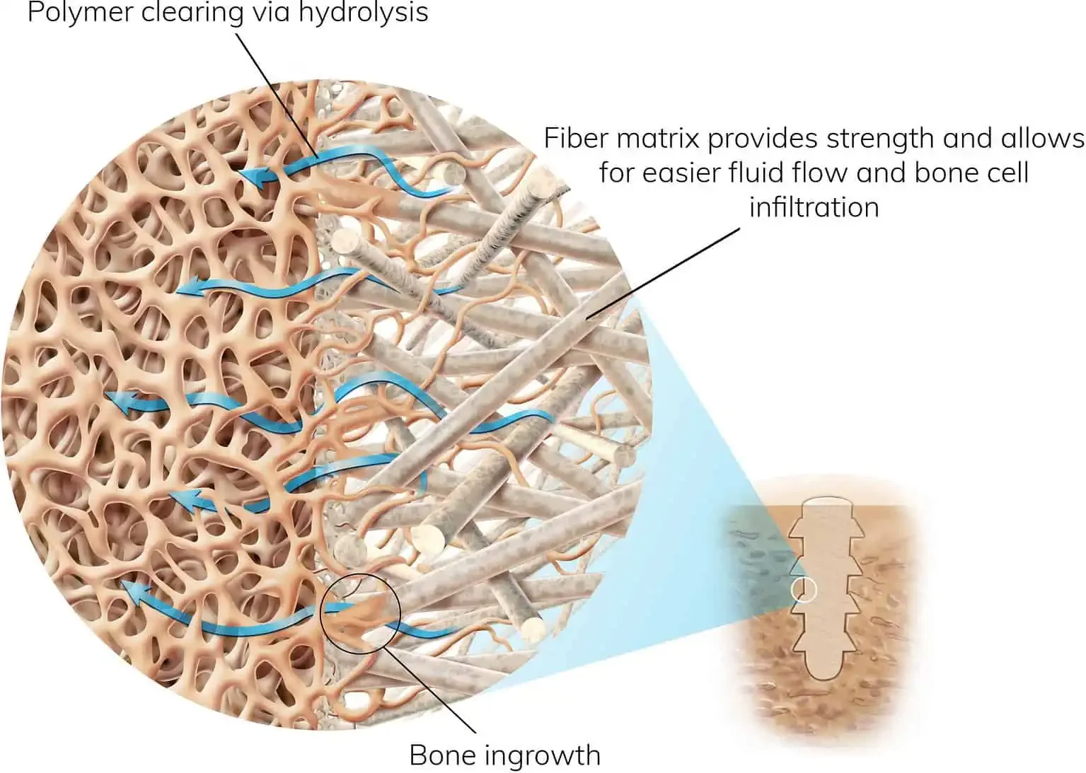 Diagram illustrating the process of polymer clearing via hydrolysis, showing bone ingrowth through a fiber matrix that provides strength and allows easier fluid flow and bone cell infiltration.