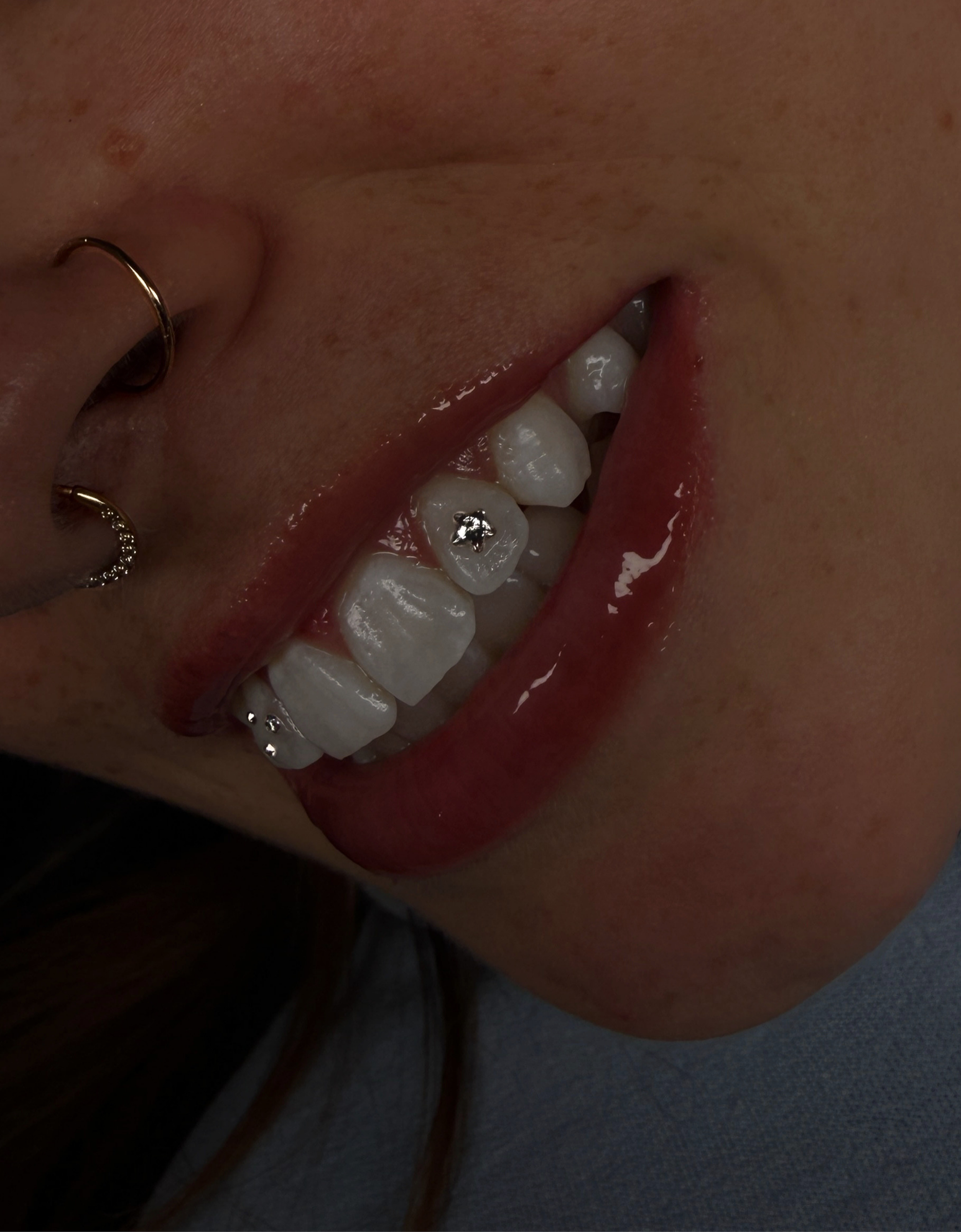Close-up of a person's mouth open, revealing teeth with dental braces and a tongue.